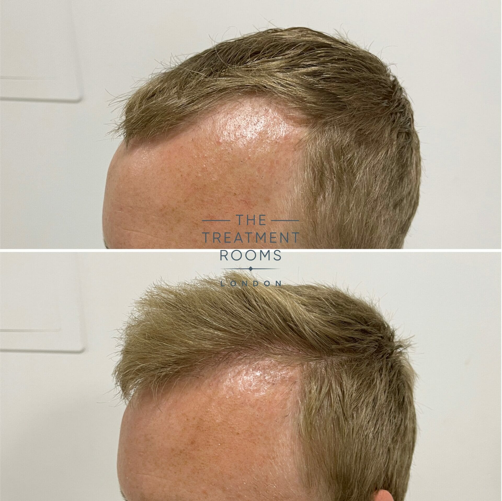 hair transplant repair before and after 1020 grafts