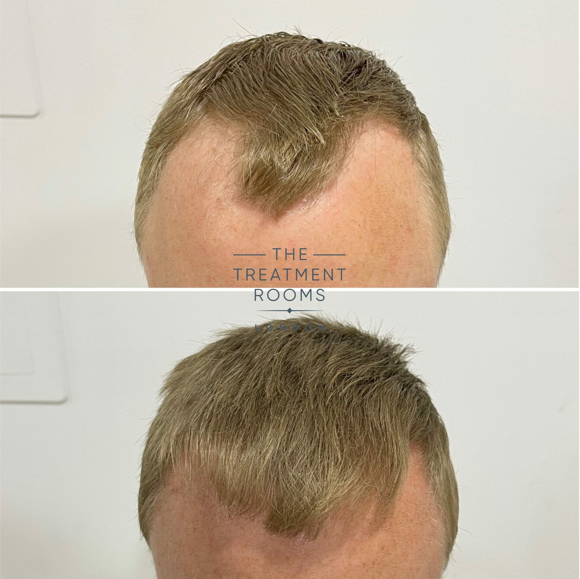 hair transplant repair result 1020 grafts