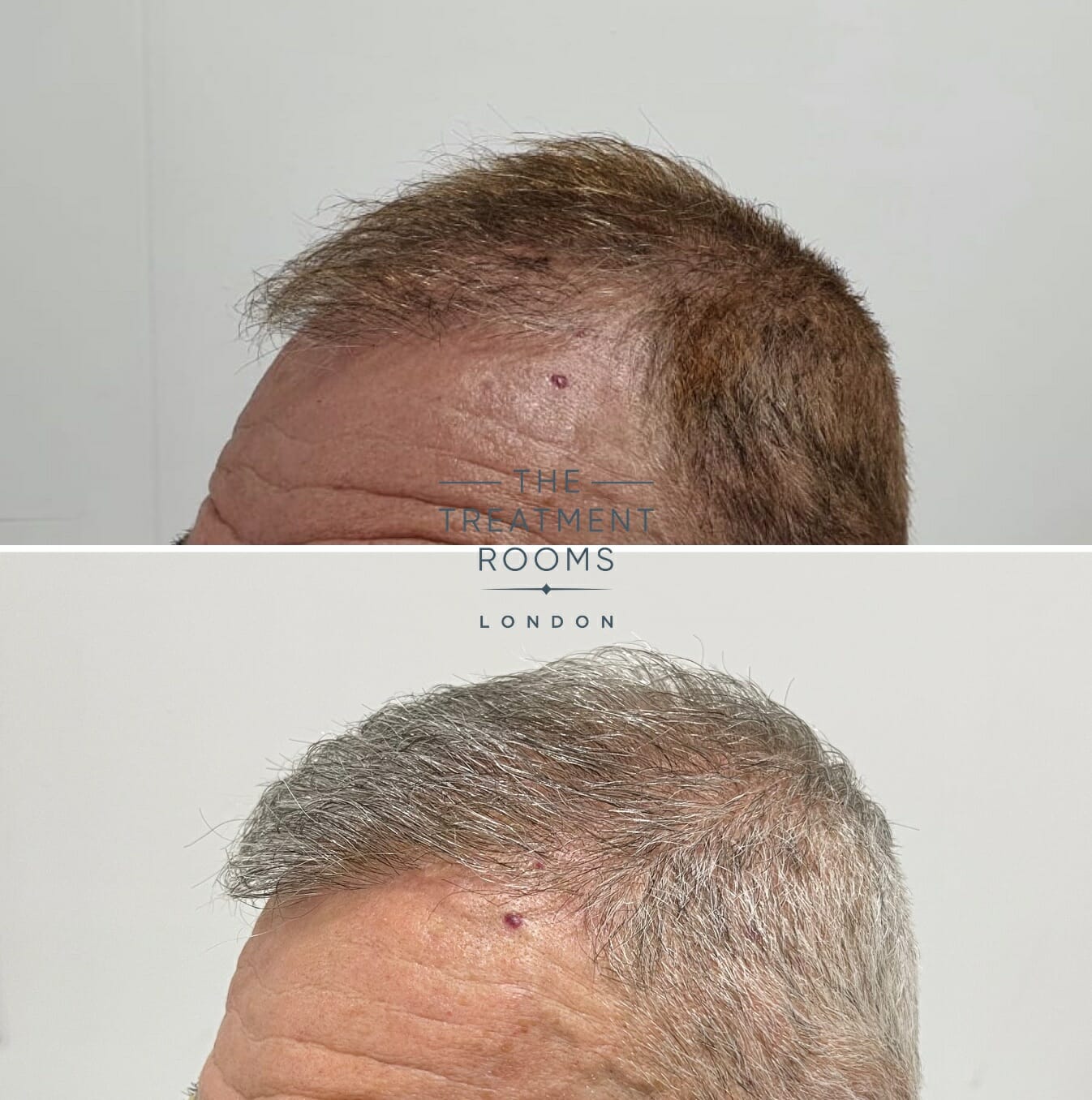 hair transplant repair result