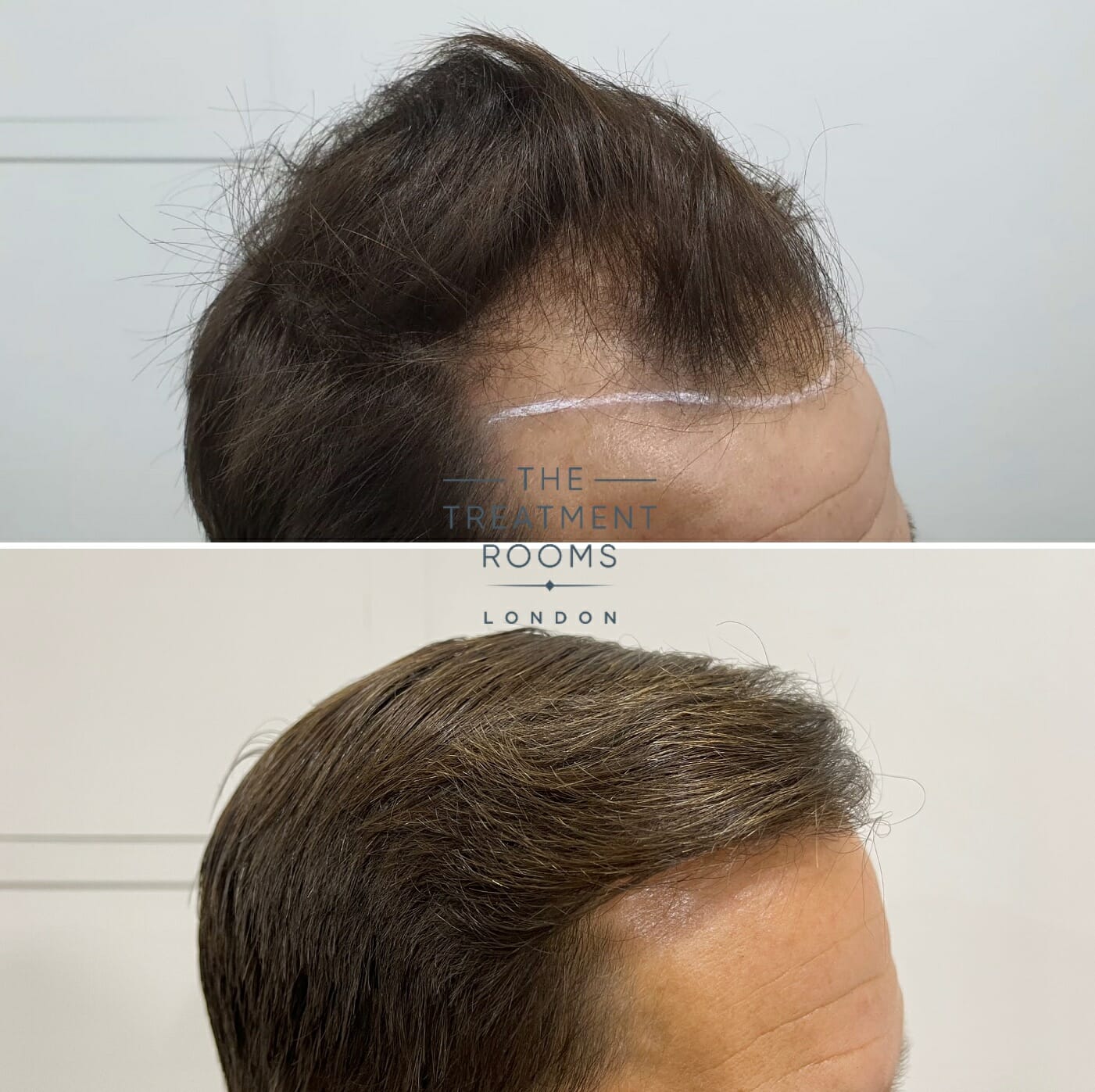 hair transplant result