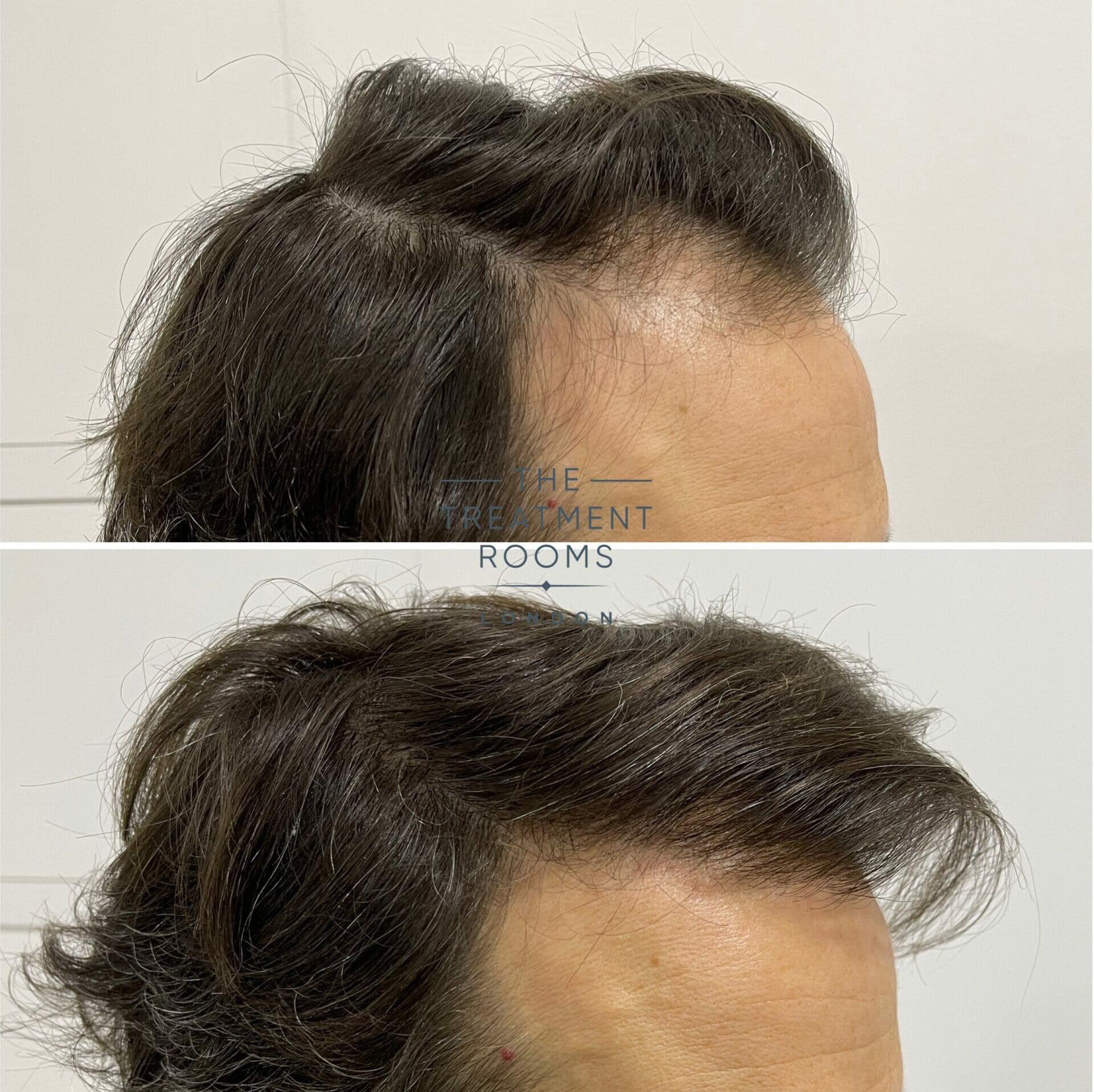 hair transplant result hairline 1840 grafts