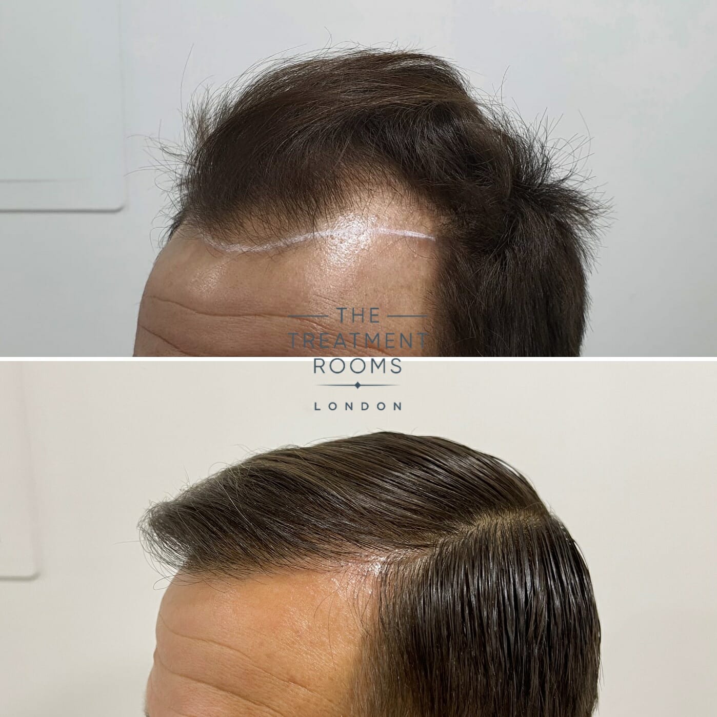 hair transplant result treatment rooms london