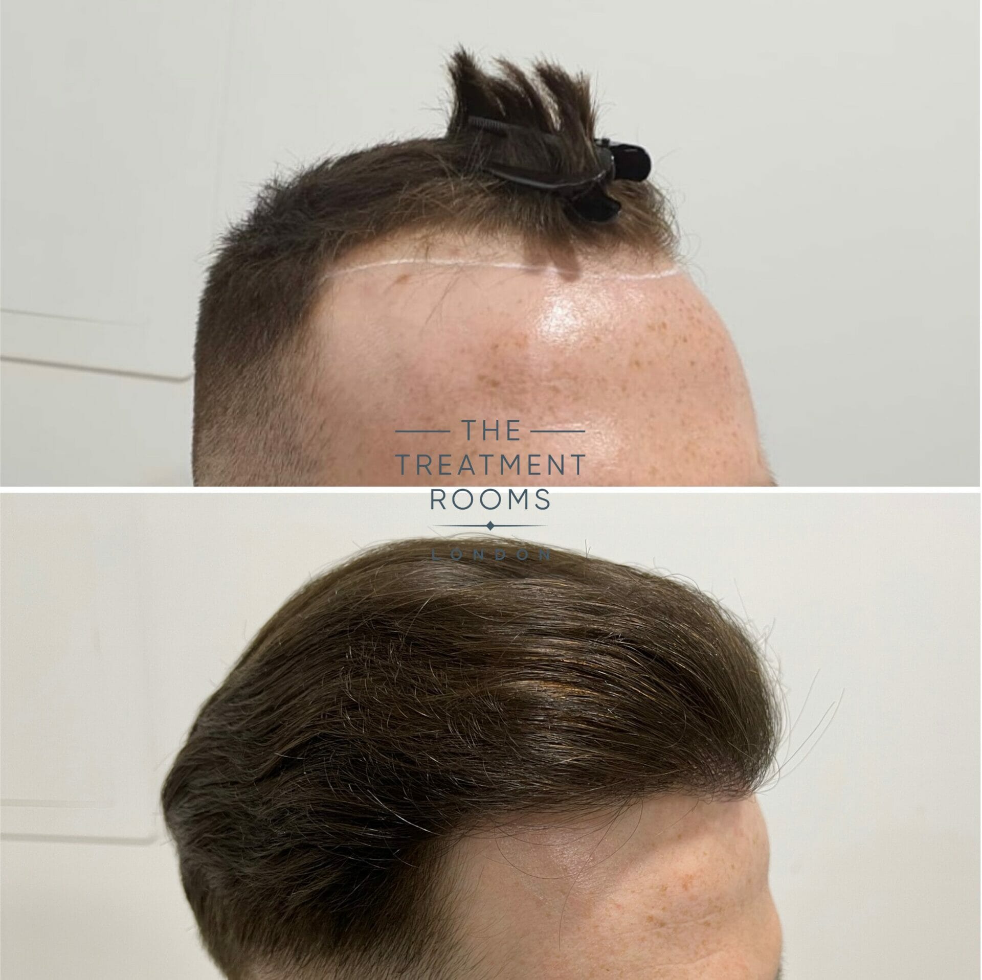 hair transplant review hairline transplant