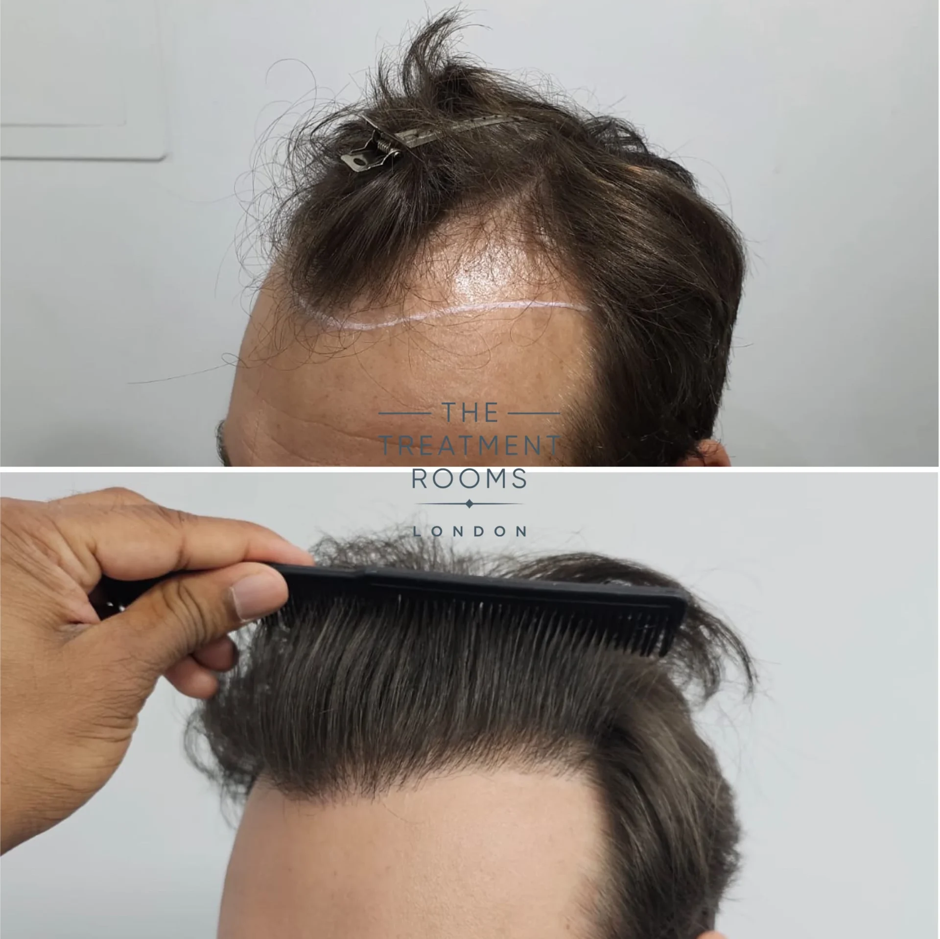 hair transplant surgery in your 20s