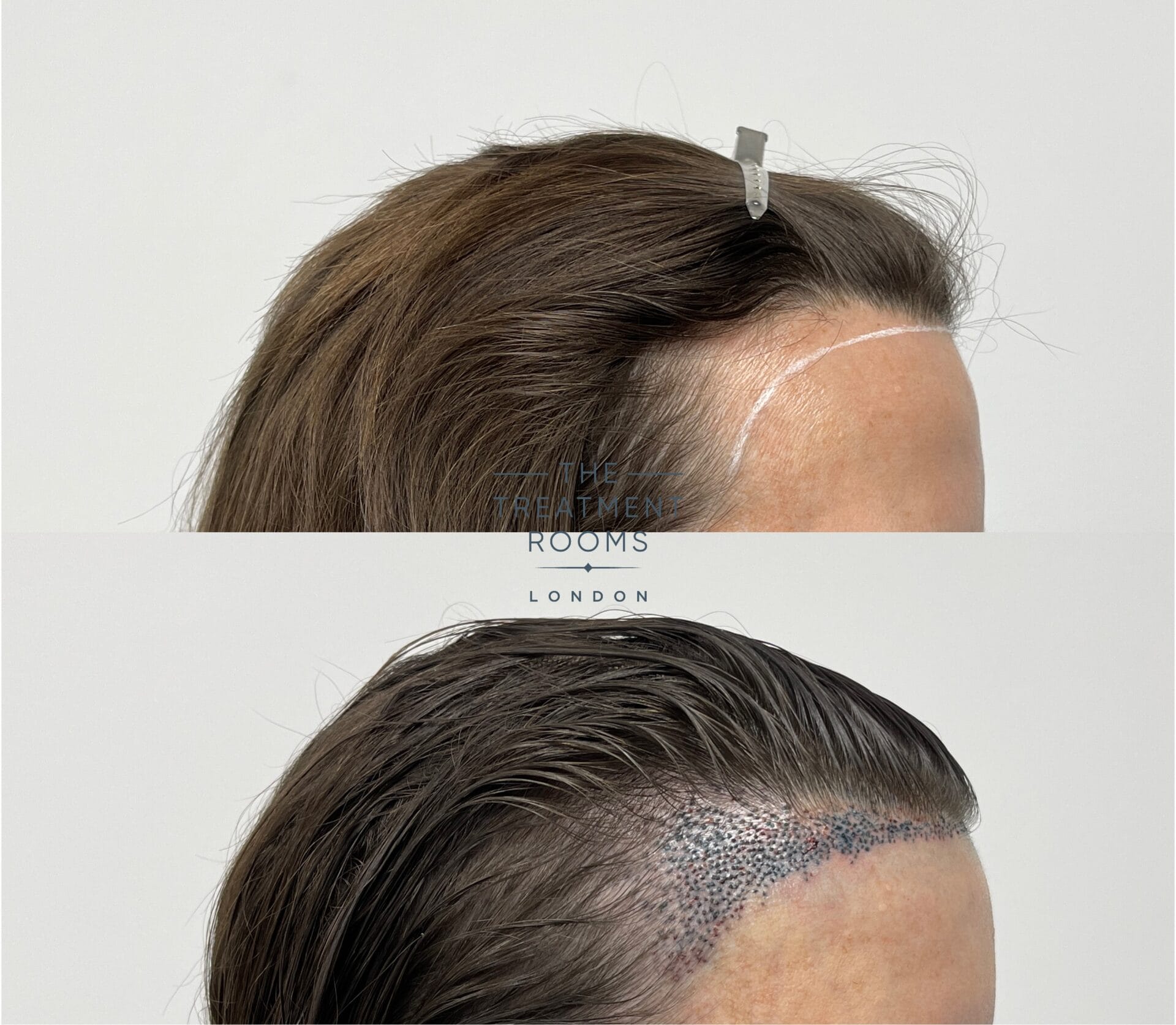 hair transplant surgery to lower hairline female