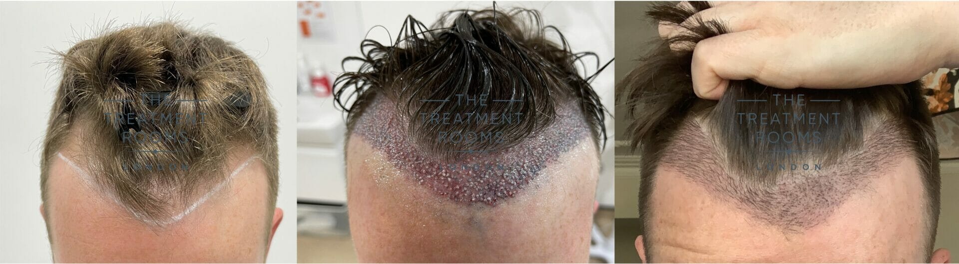 hair transplant with long hair