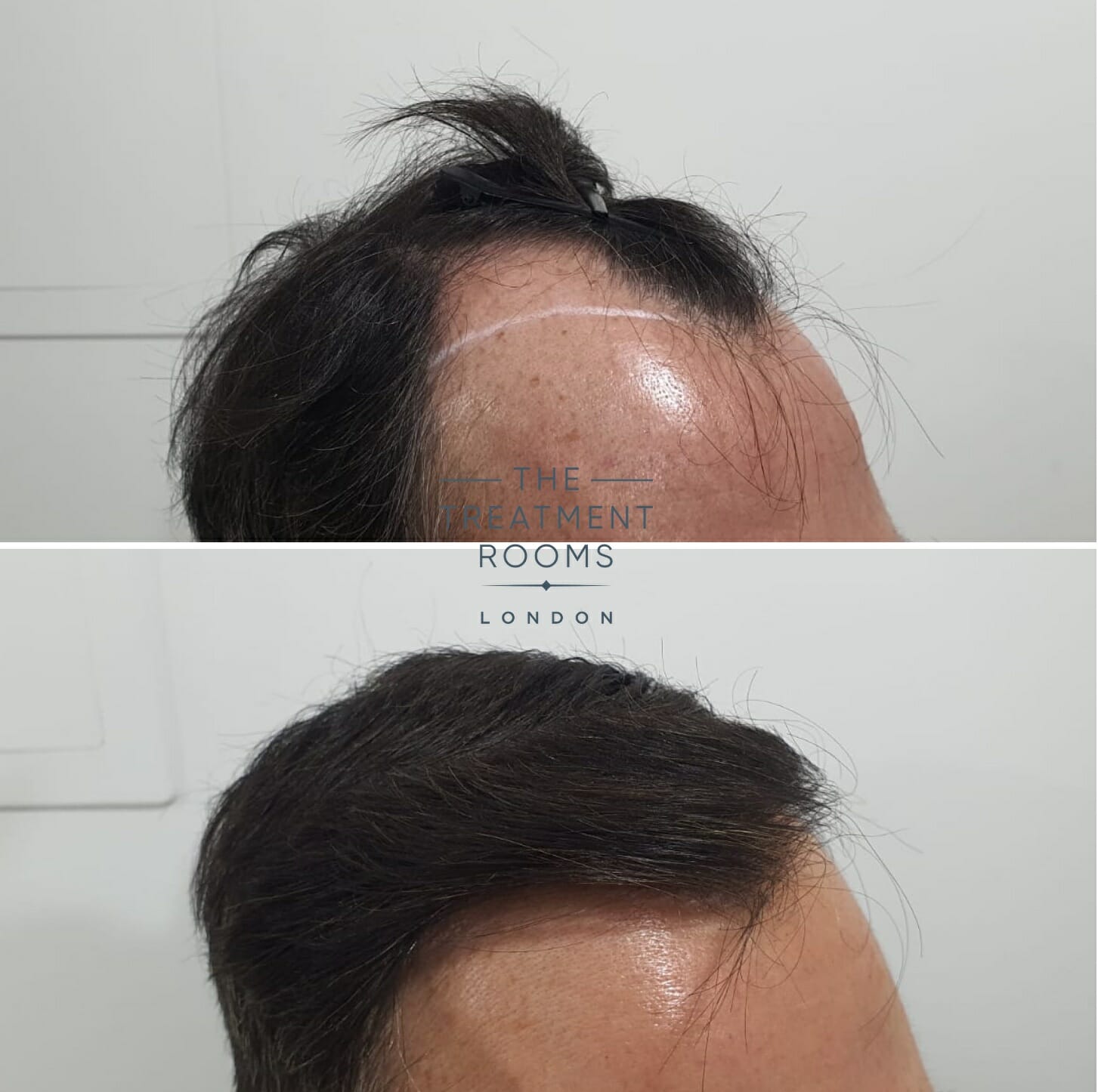 hairline FUE hair transplant before and after 1800 grafts