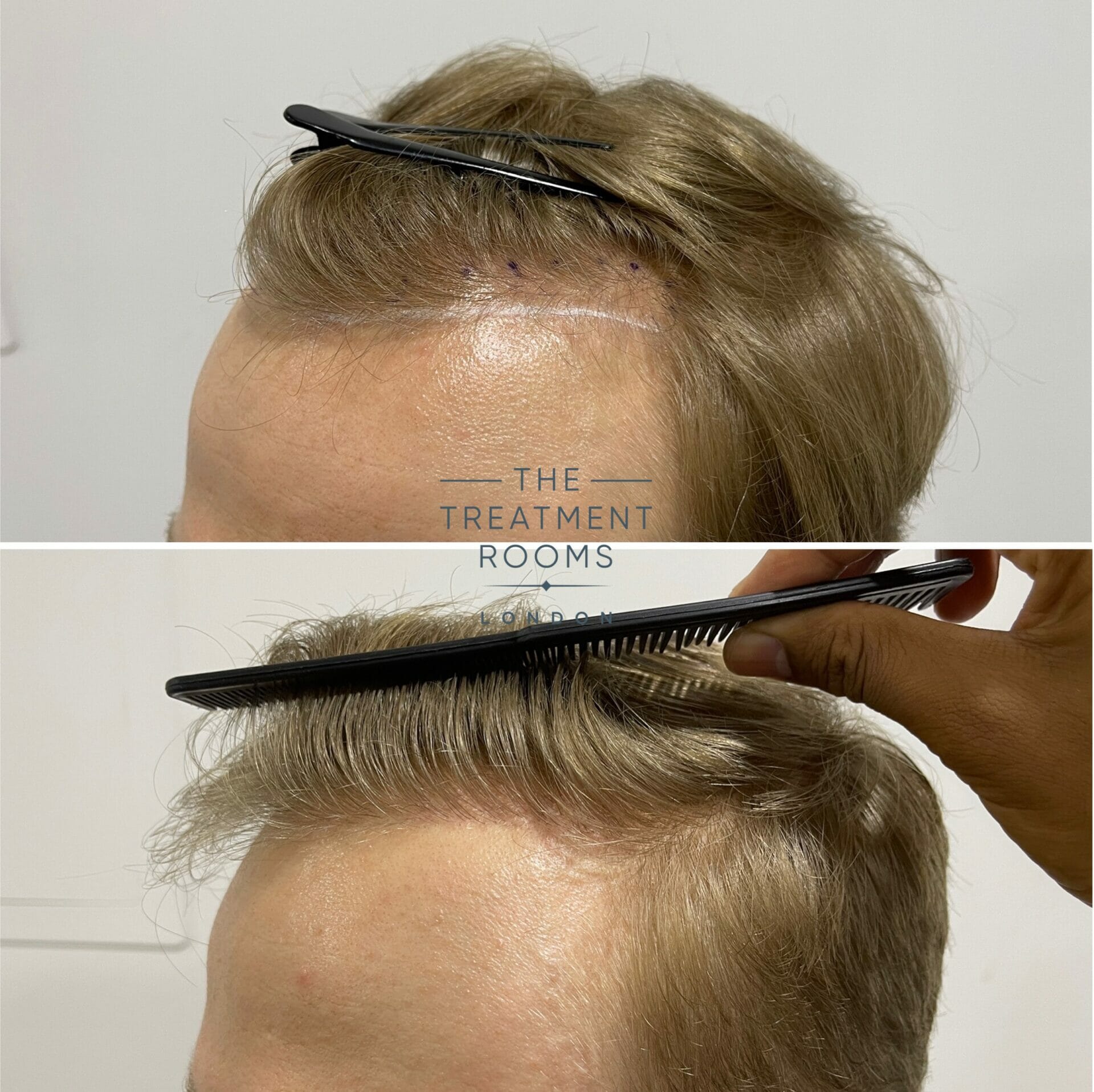 hairline dhi hair transplant 616 grafts