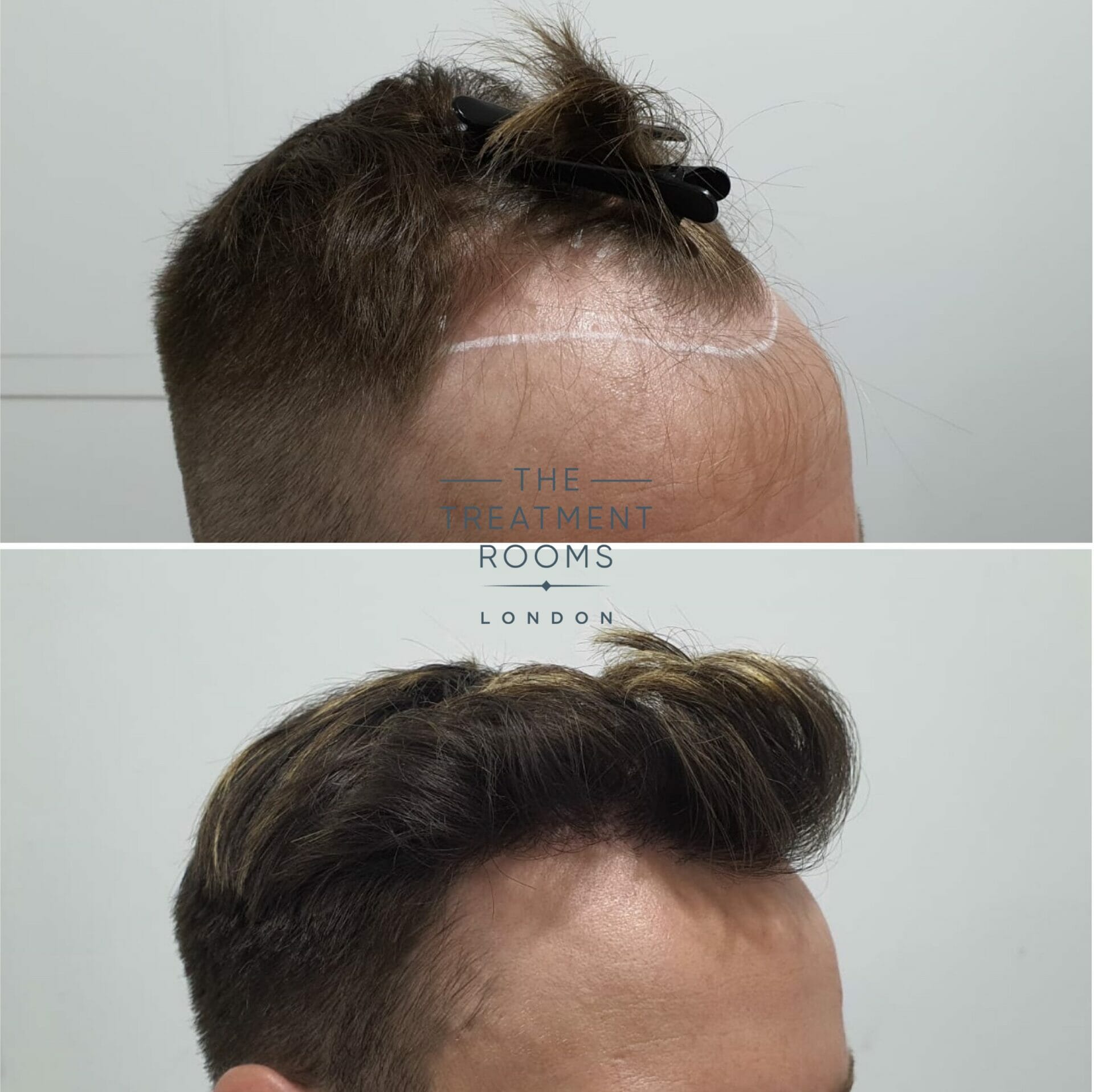 hairline dhi hair transplant before and after 1724 grafts