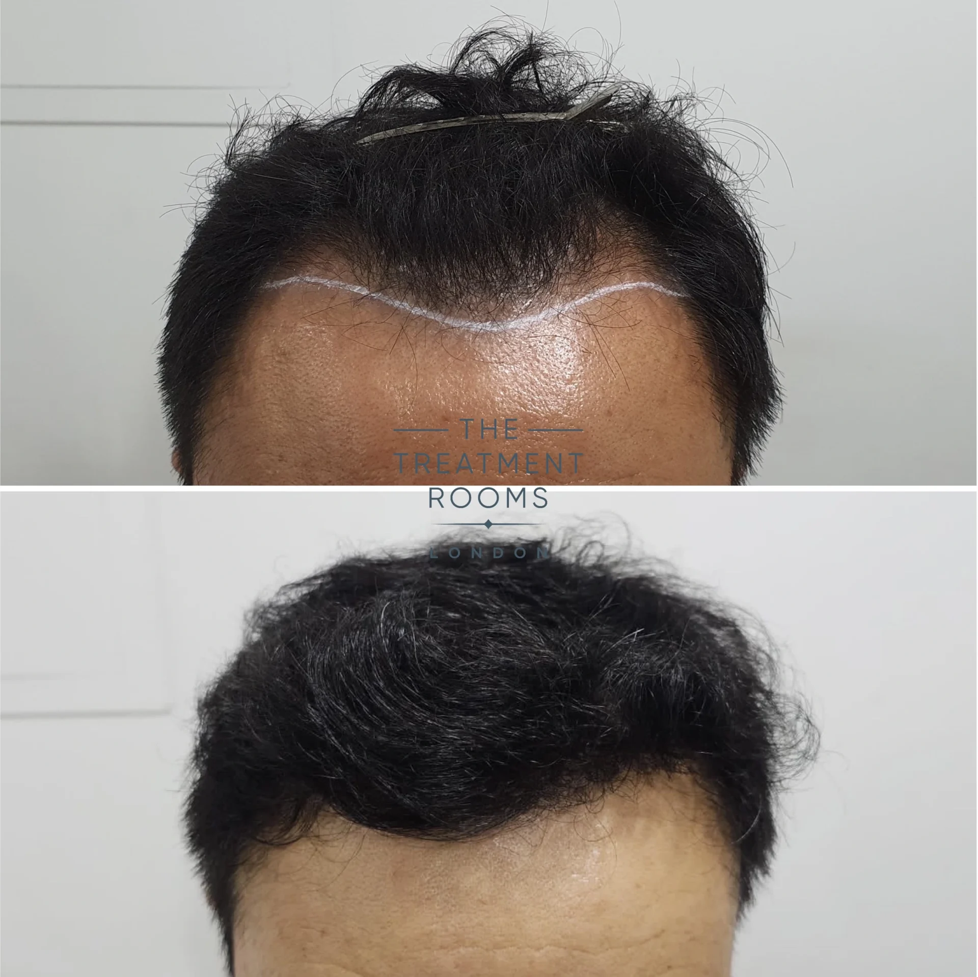 hairline fue hair transplant 1178 grafts result