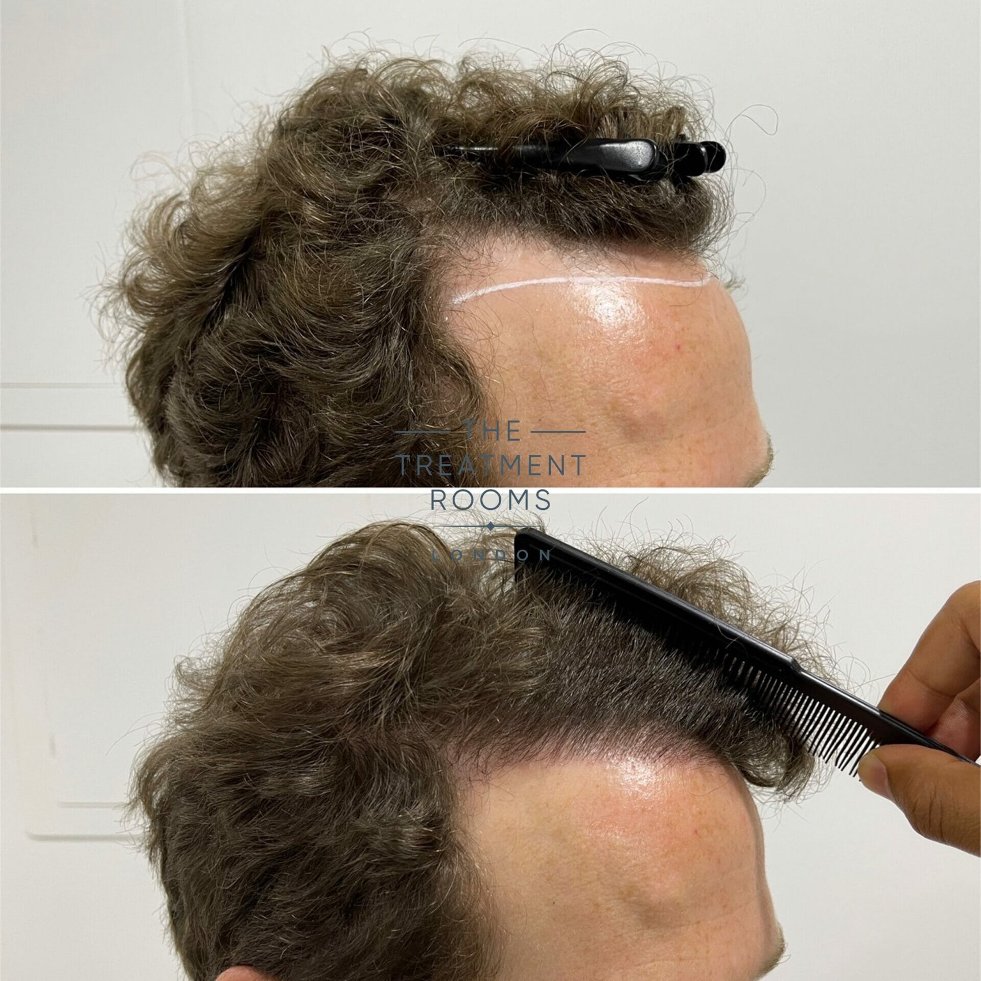 hairline fue hair transplant 1304 grafts