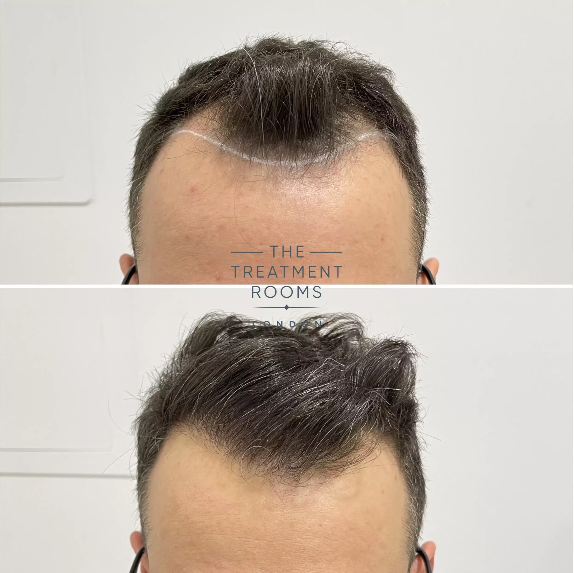 hairline fue hair transplant 1321 grafts before and after