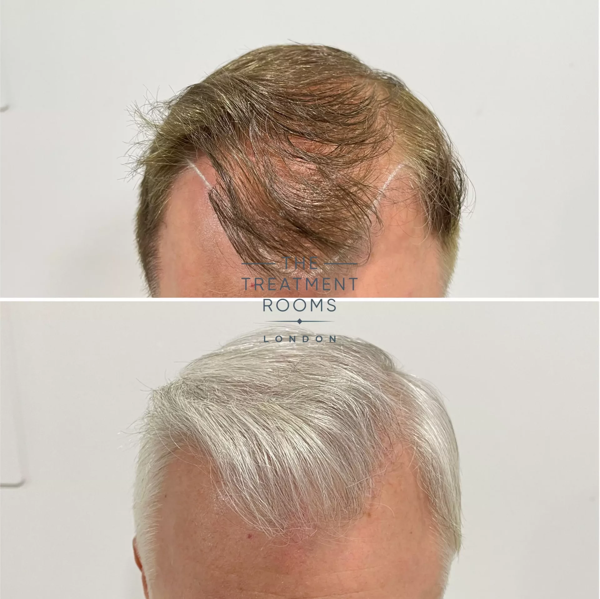 hairline fue hair transplant 1495 grafts before and after