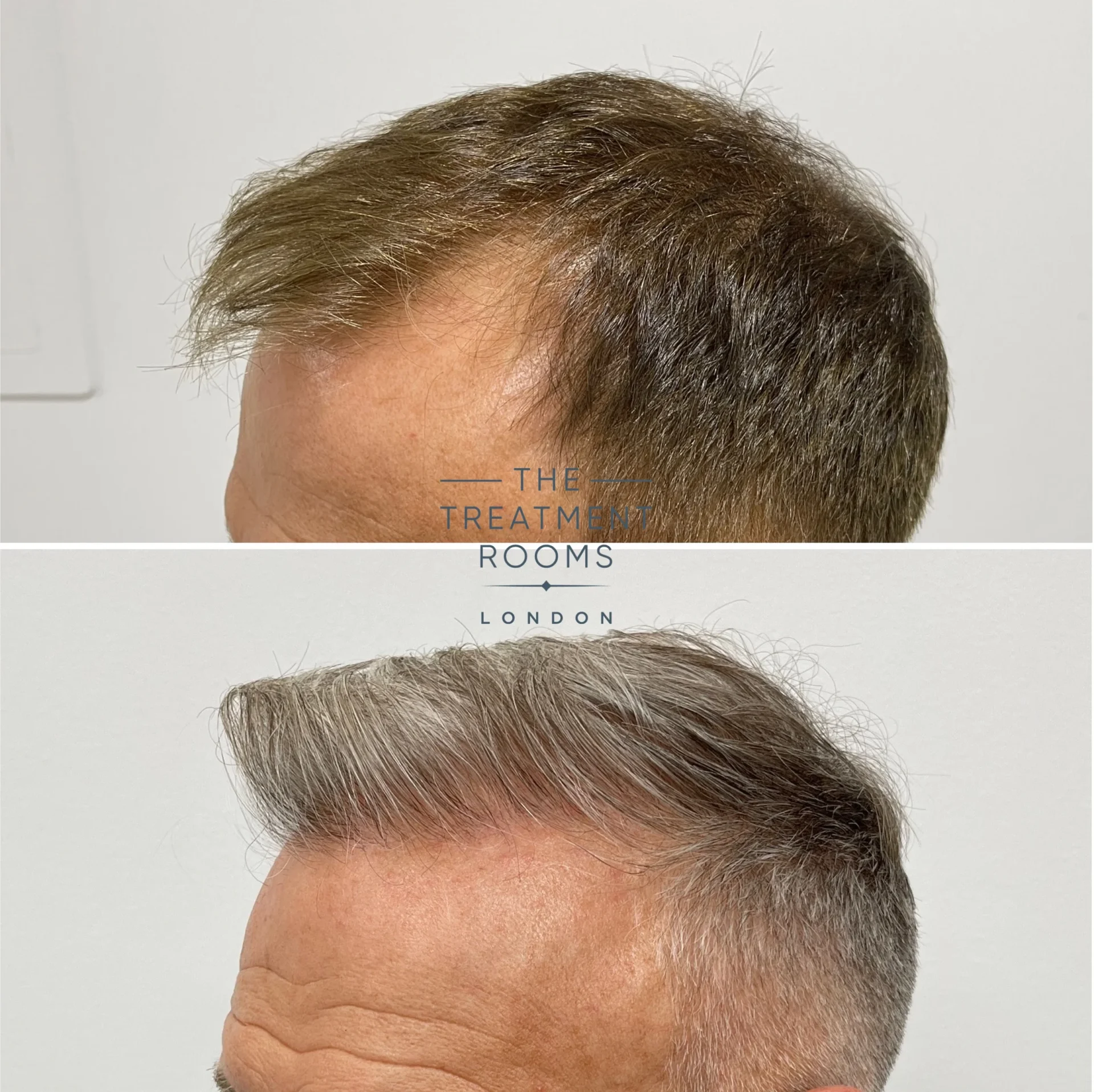hairline fue hair transplant 1602 grafts before and after.