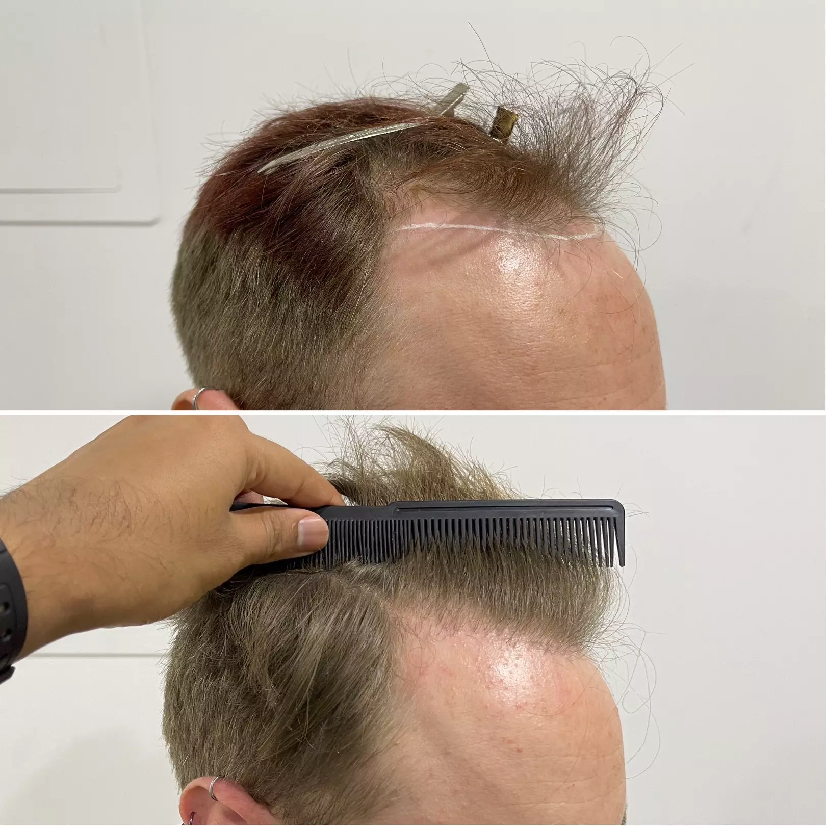 hairline fue hair transplant 1693 grafts before and after