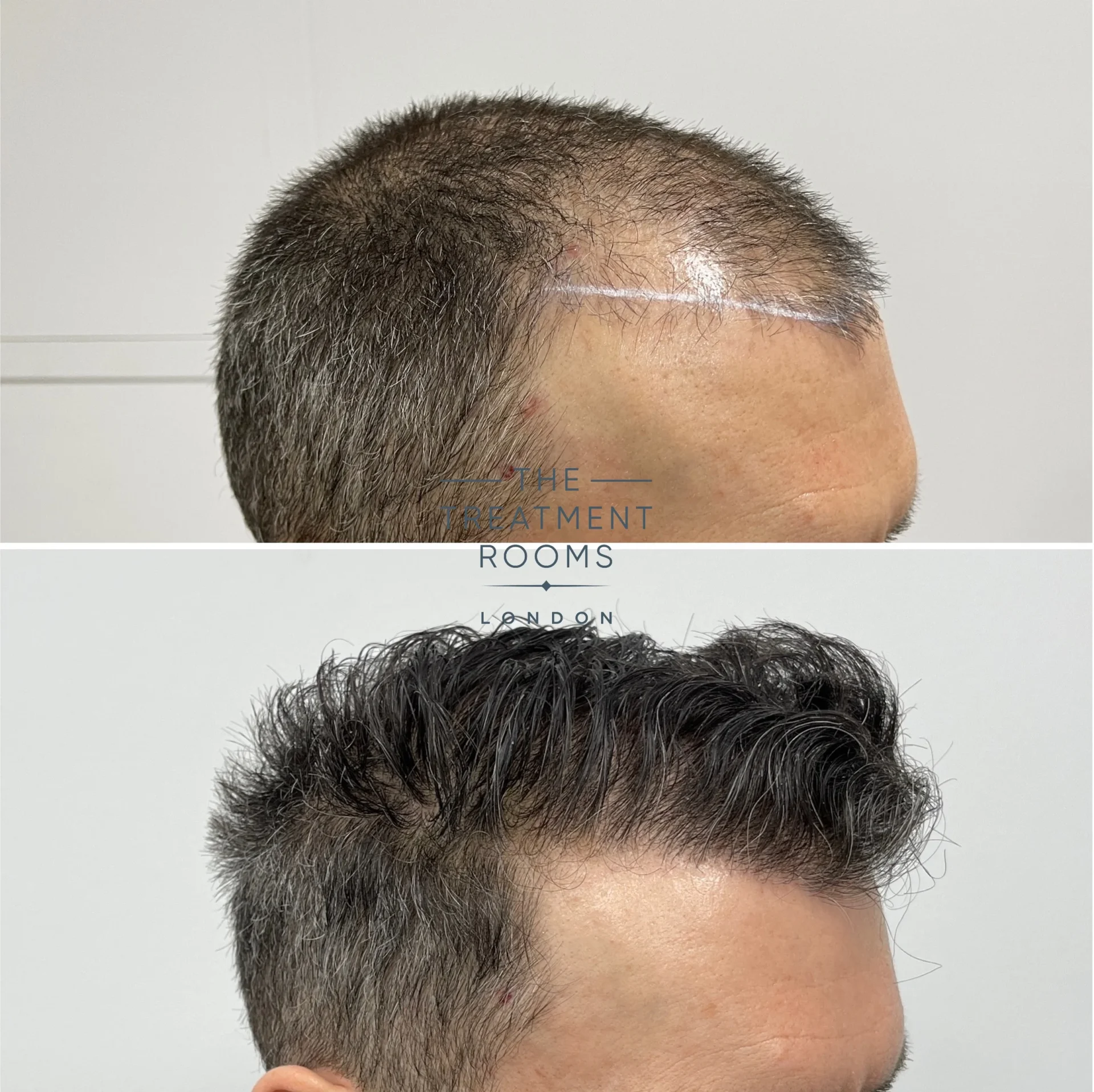 hairline fue hair transplant 1748 grafts before and after