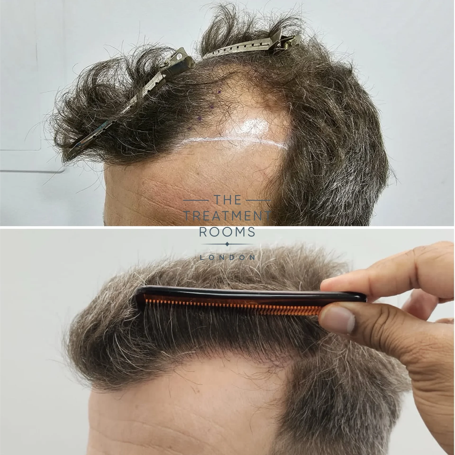hairline fue hair transplant 1977 grafts grey hair