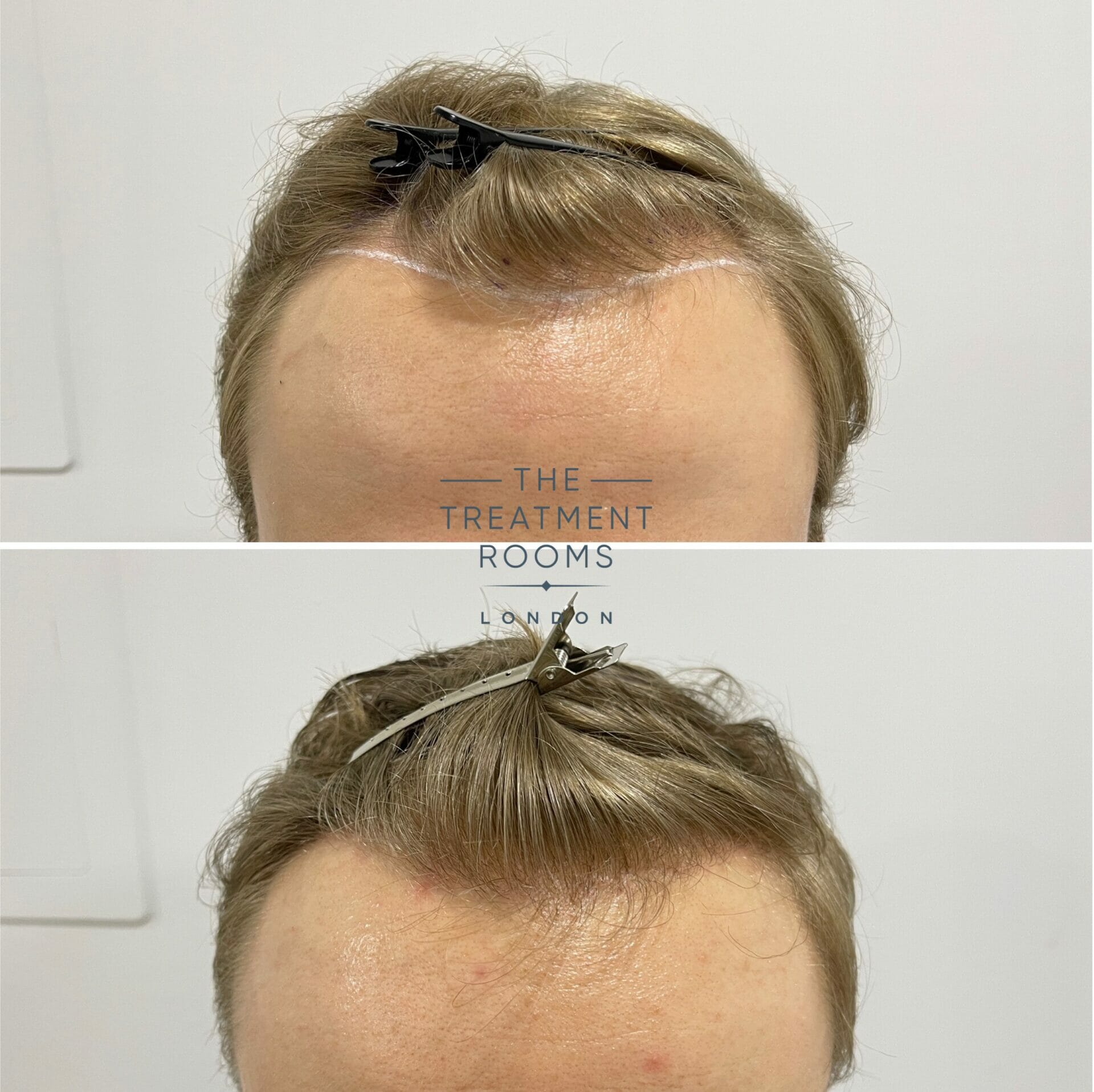 hairline fue hair transplant 616 grafts