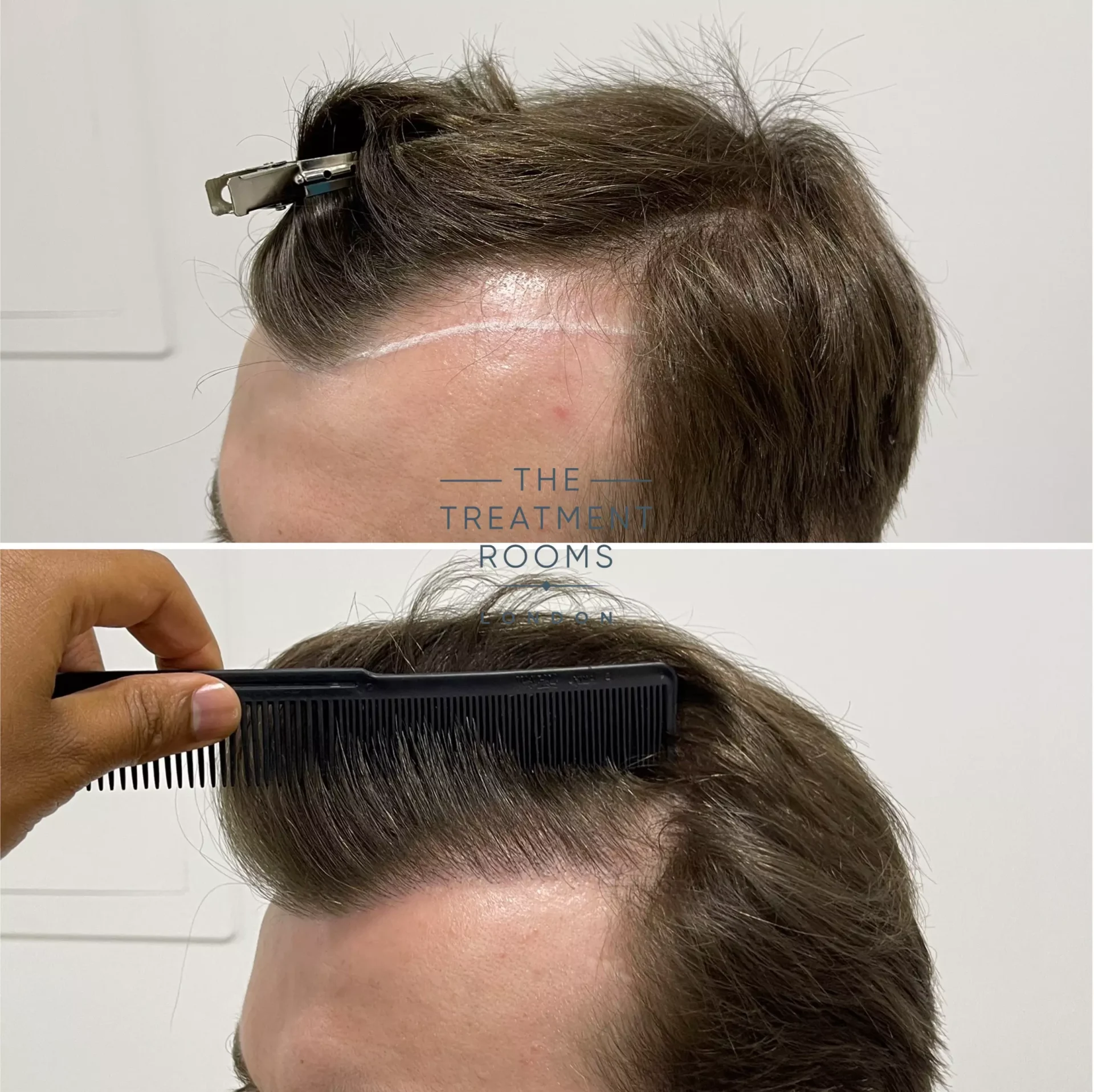 hairline fue hair transplant before and after 1357 grafts