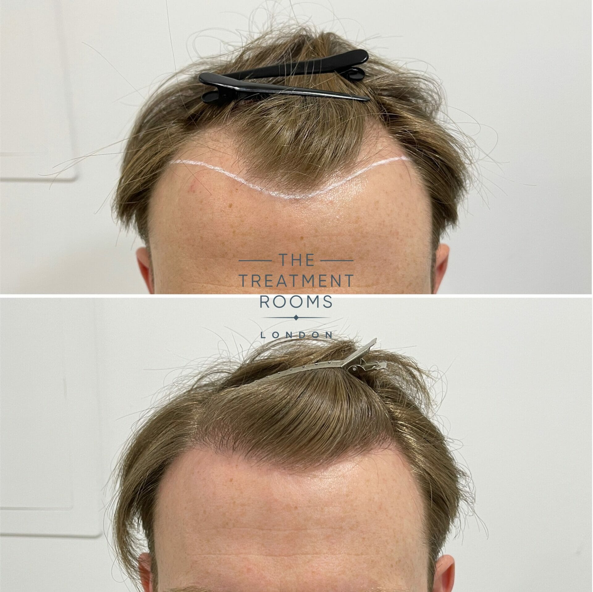 hairline fue hair transplant before and after 1700 grafts