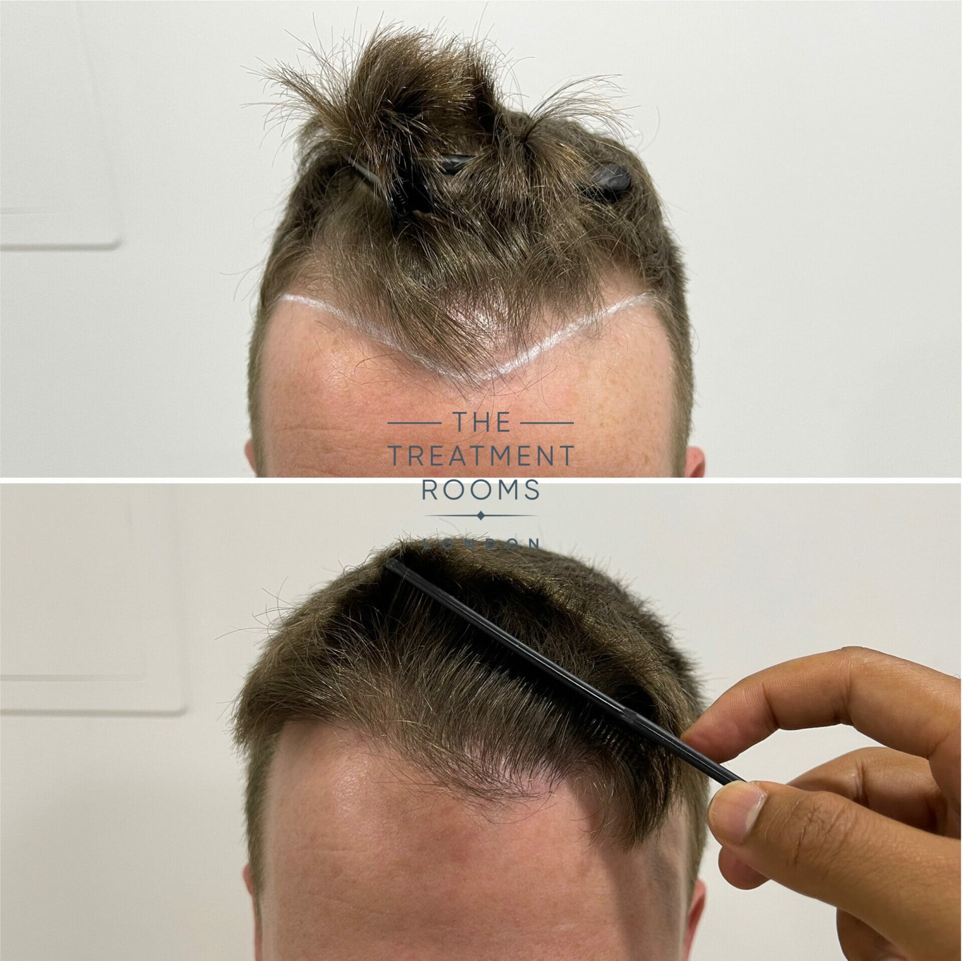 hairline fue hair transplant before and after closeup