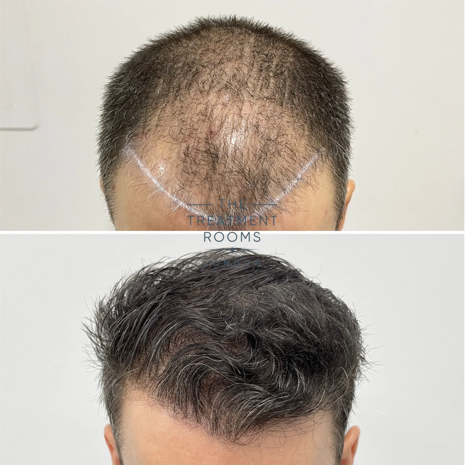 hairline fue hair transplant london 1748 grafts before and after