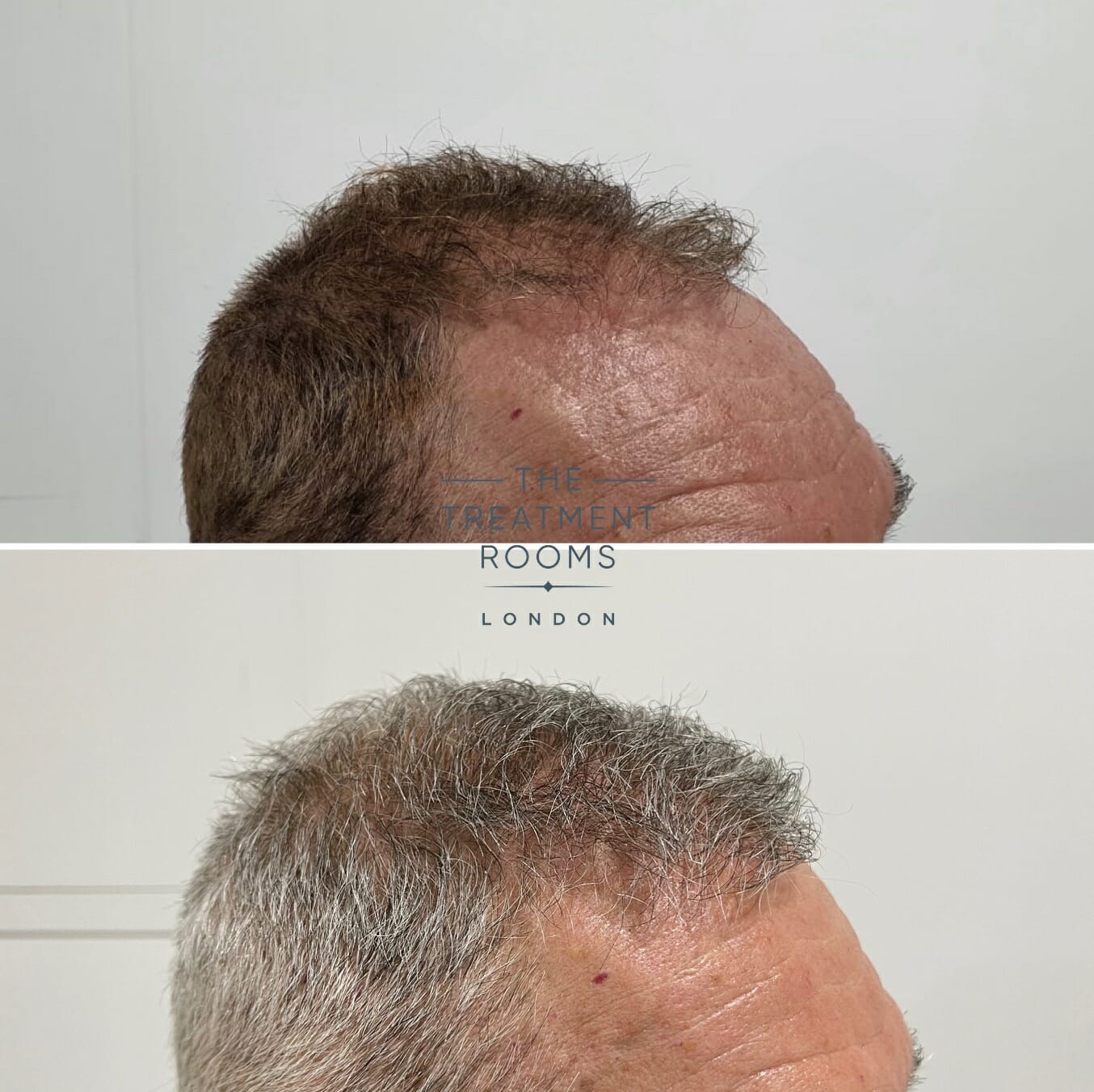 hairline fue hair transplant repair result