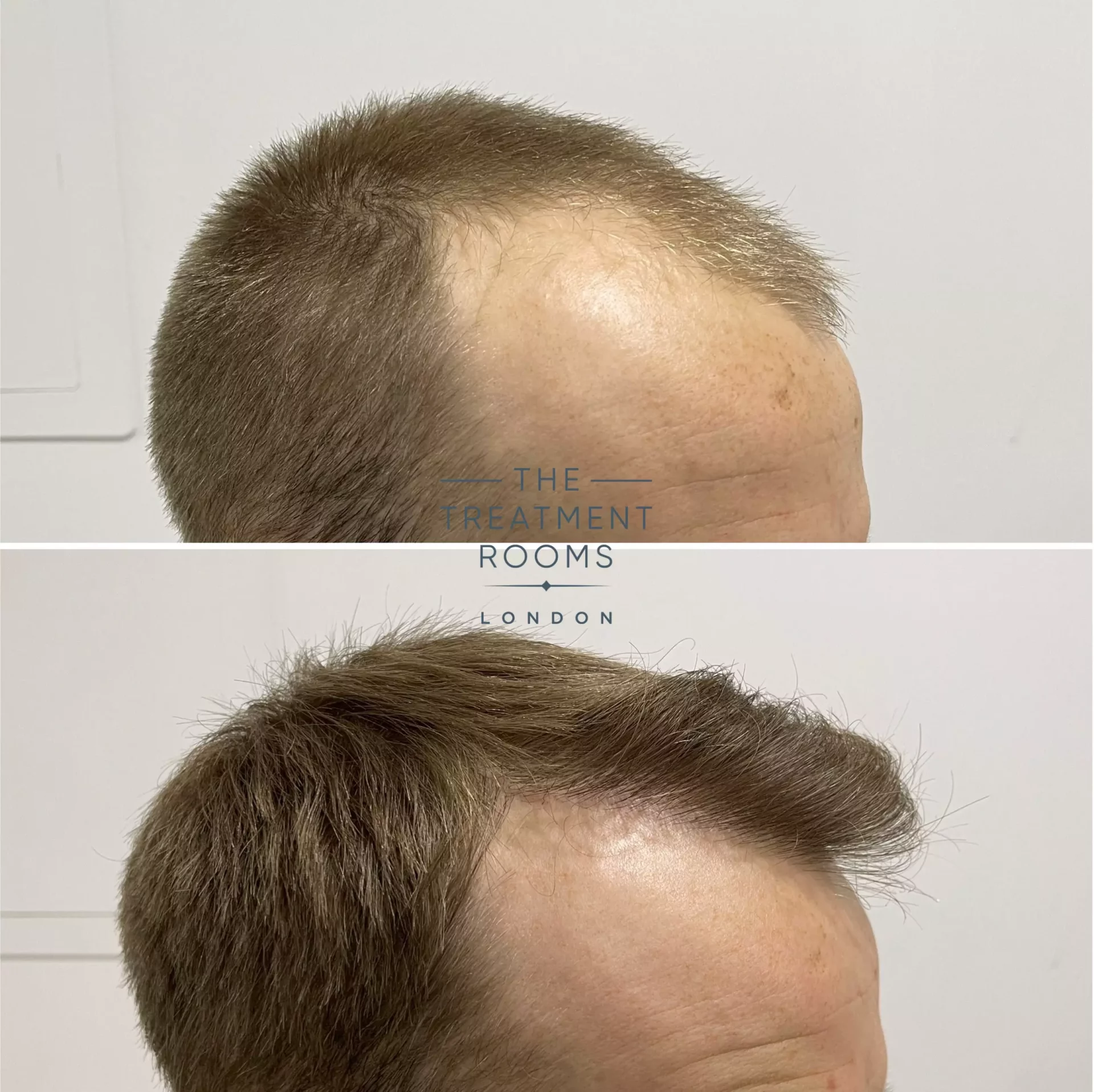 hairline fue hair transplant result 1756 grafts