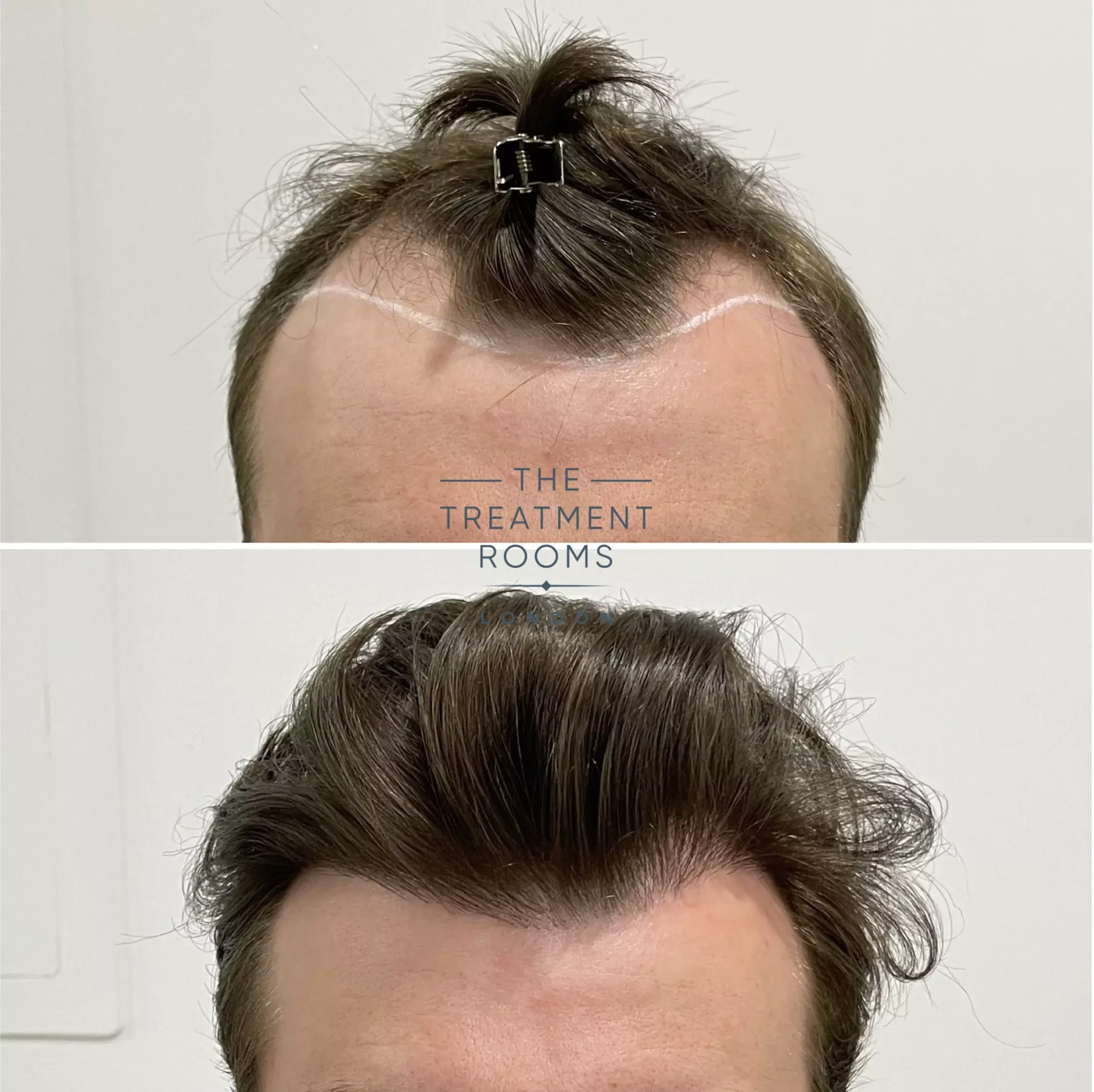 hairline fue hair transplant result before and after 1357 grafts