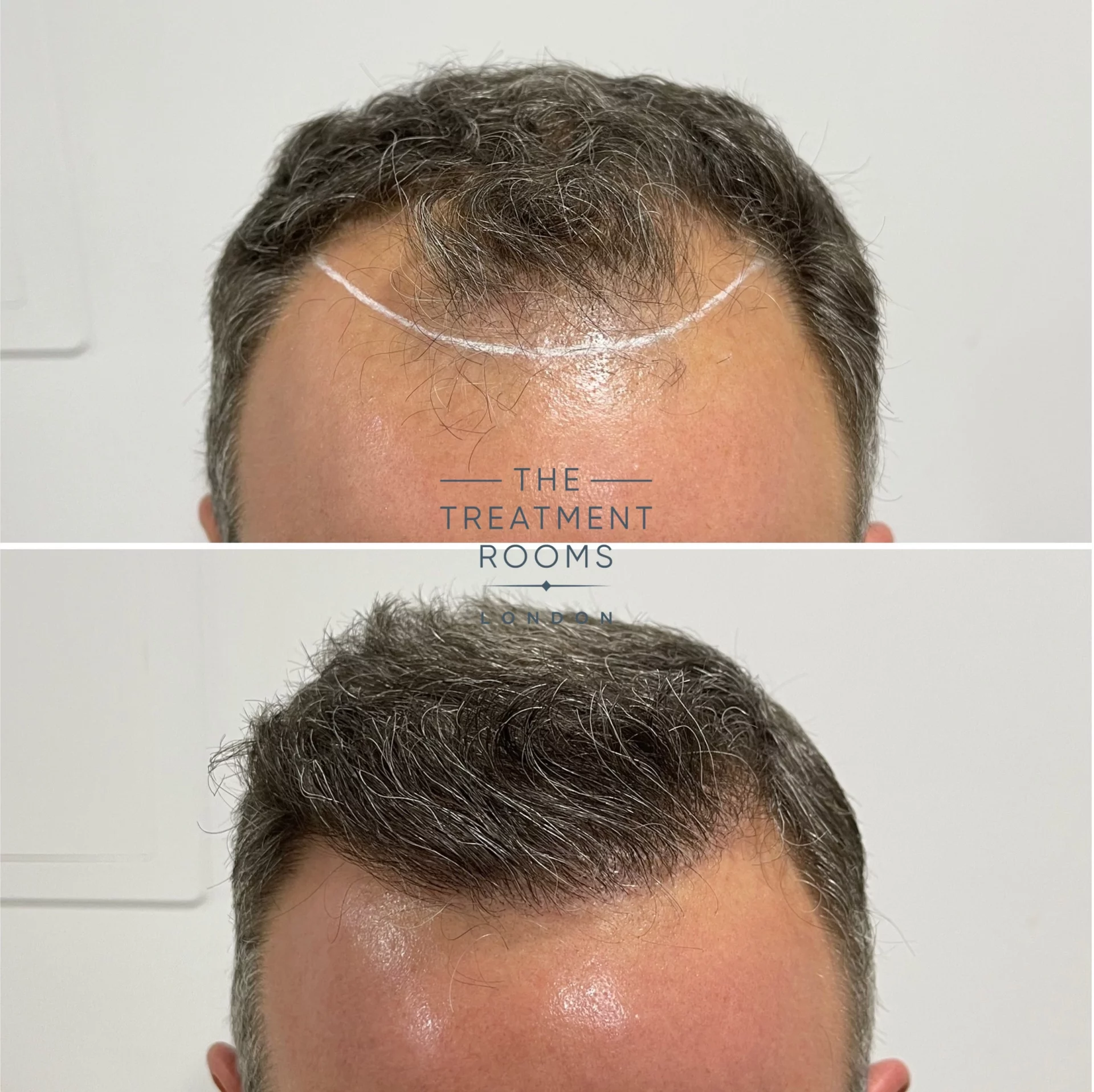 hairline fue transplant 1788 grafts before and after