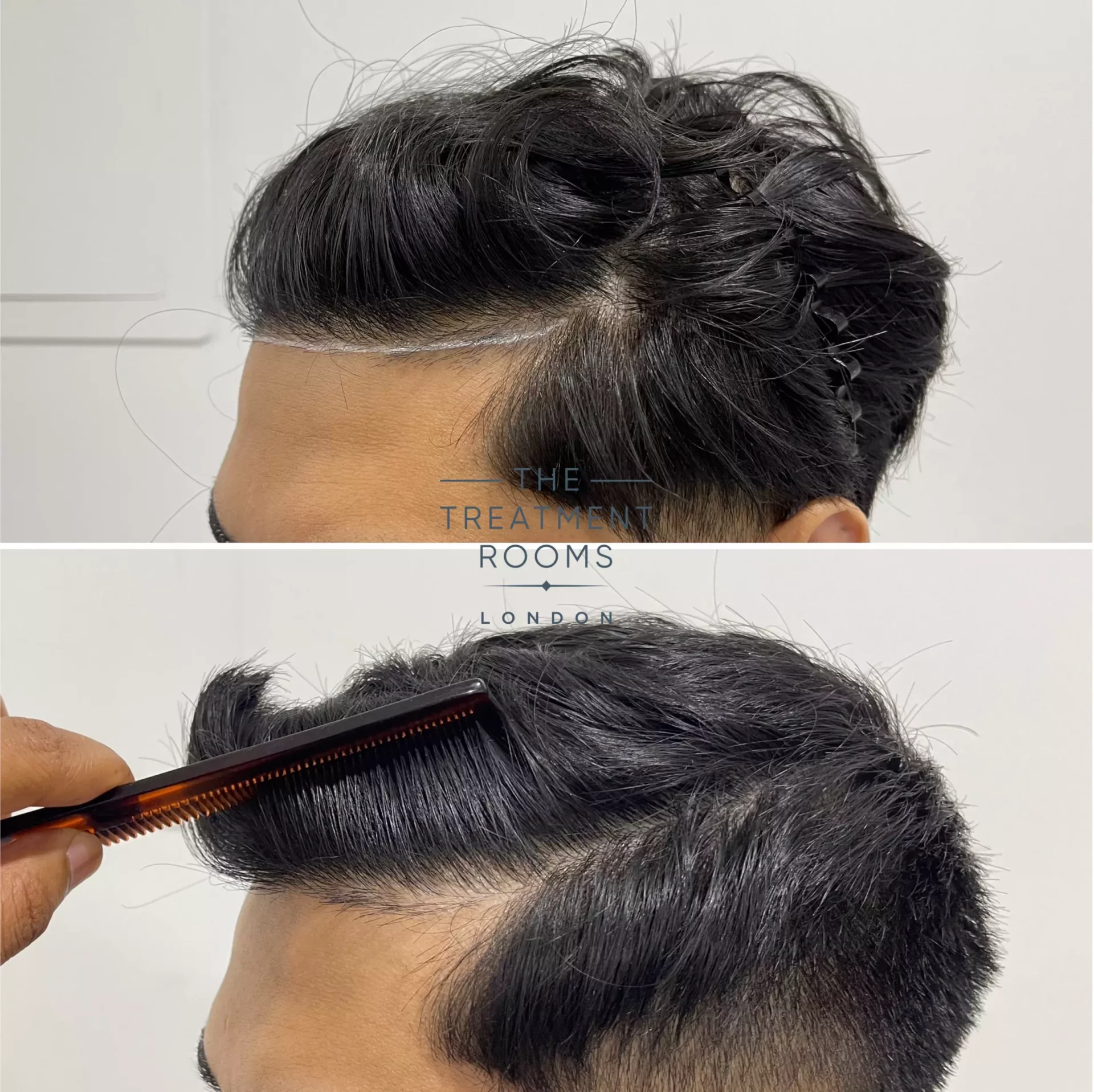 hairline fue transplant london 1019 grafts