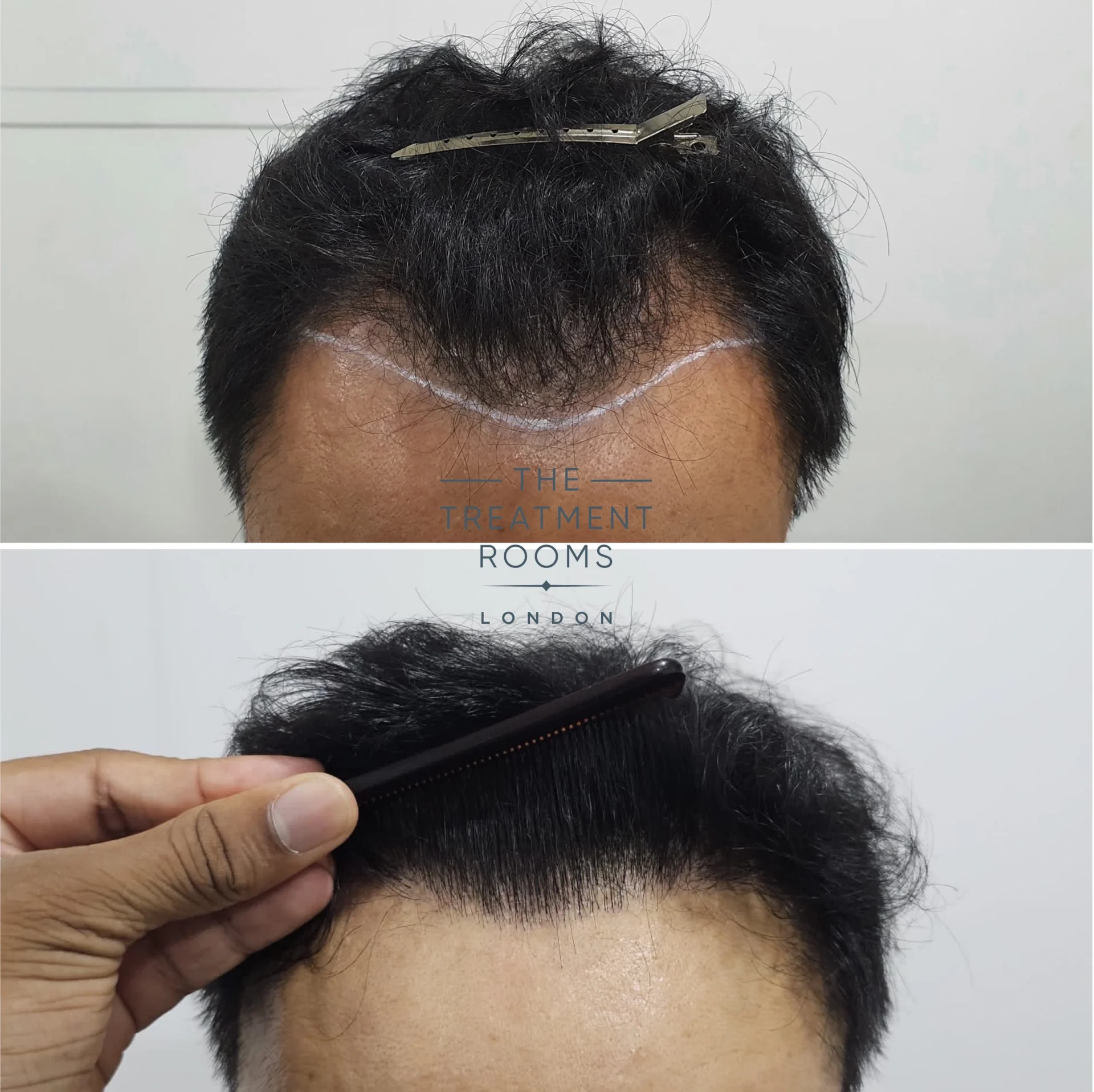 hairline hair transplant 1178 grafts before and after