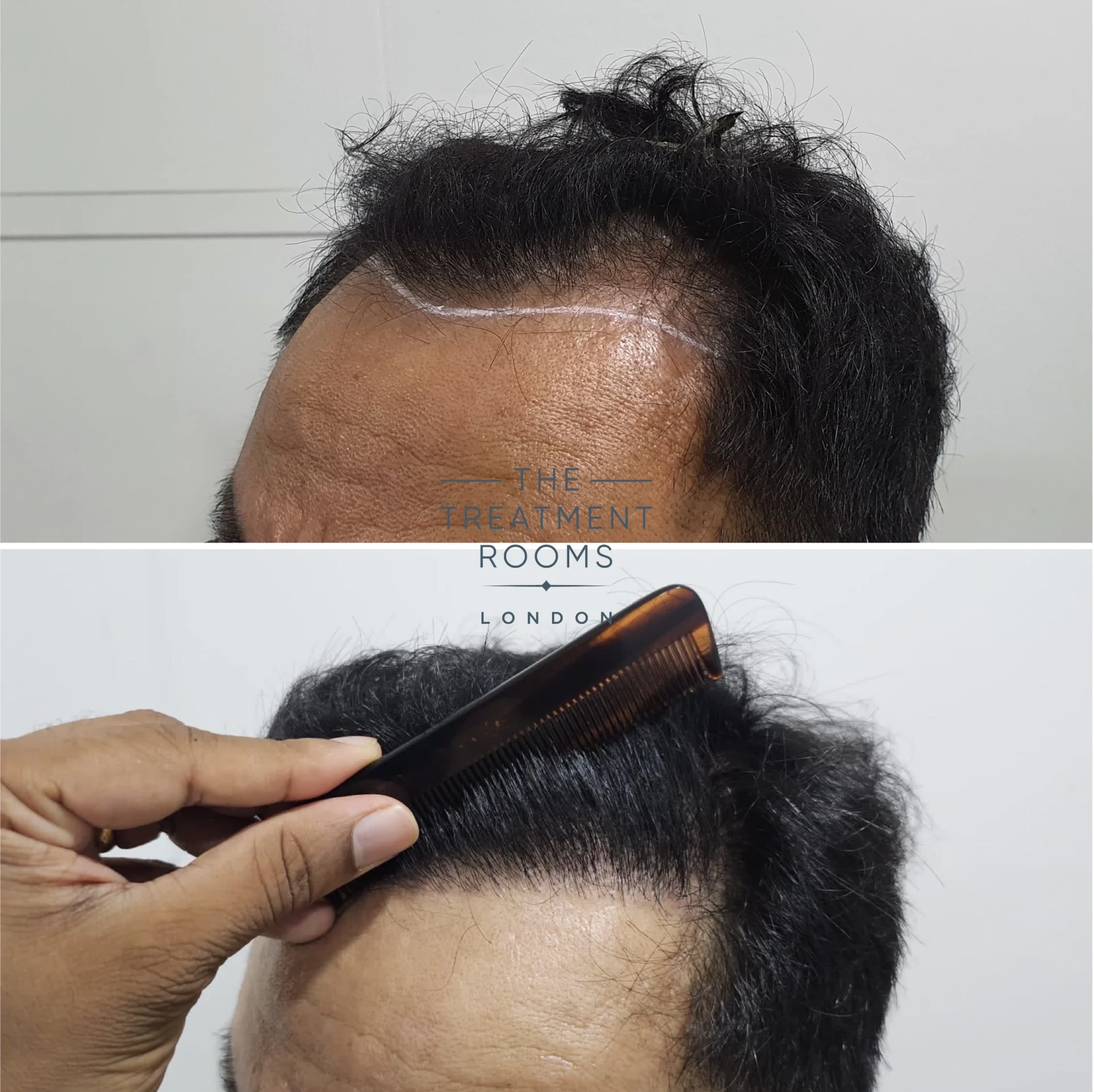 hairline hair transplant 1178 grafts result