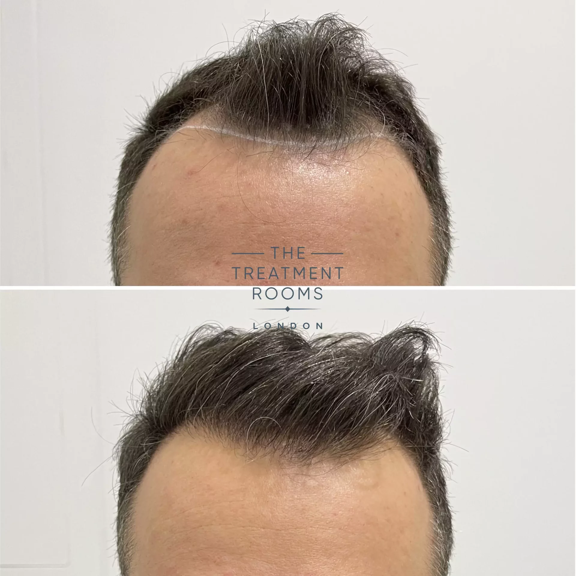 hairline hair transplant 1321 grafts before and after