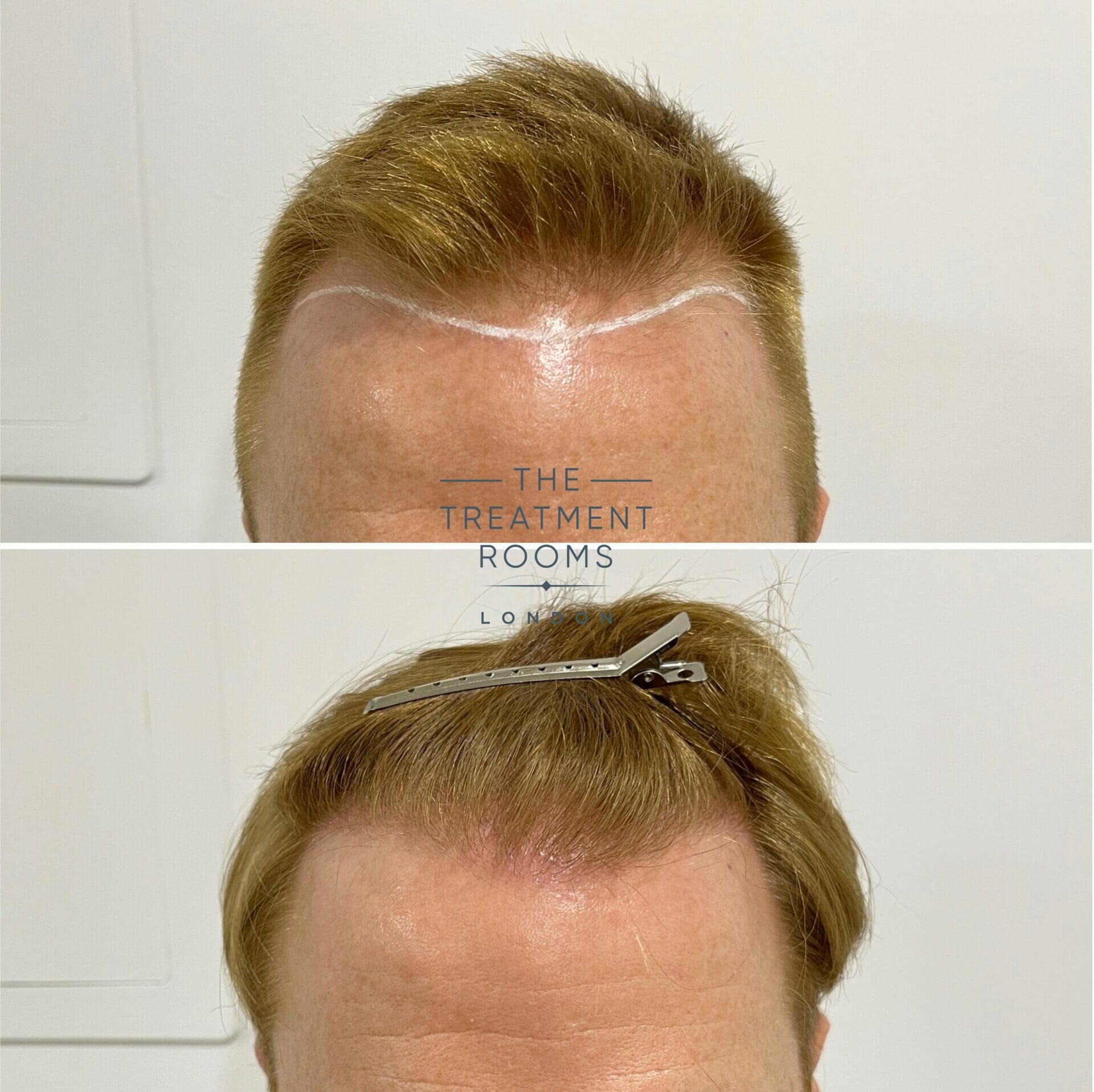 hairline hair transplant 1426 grafts before and after