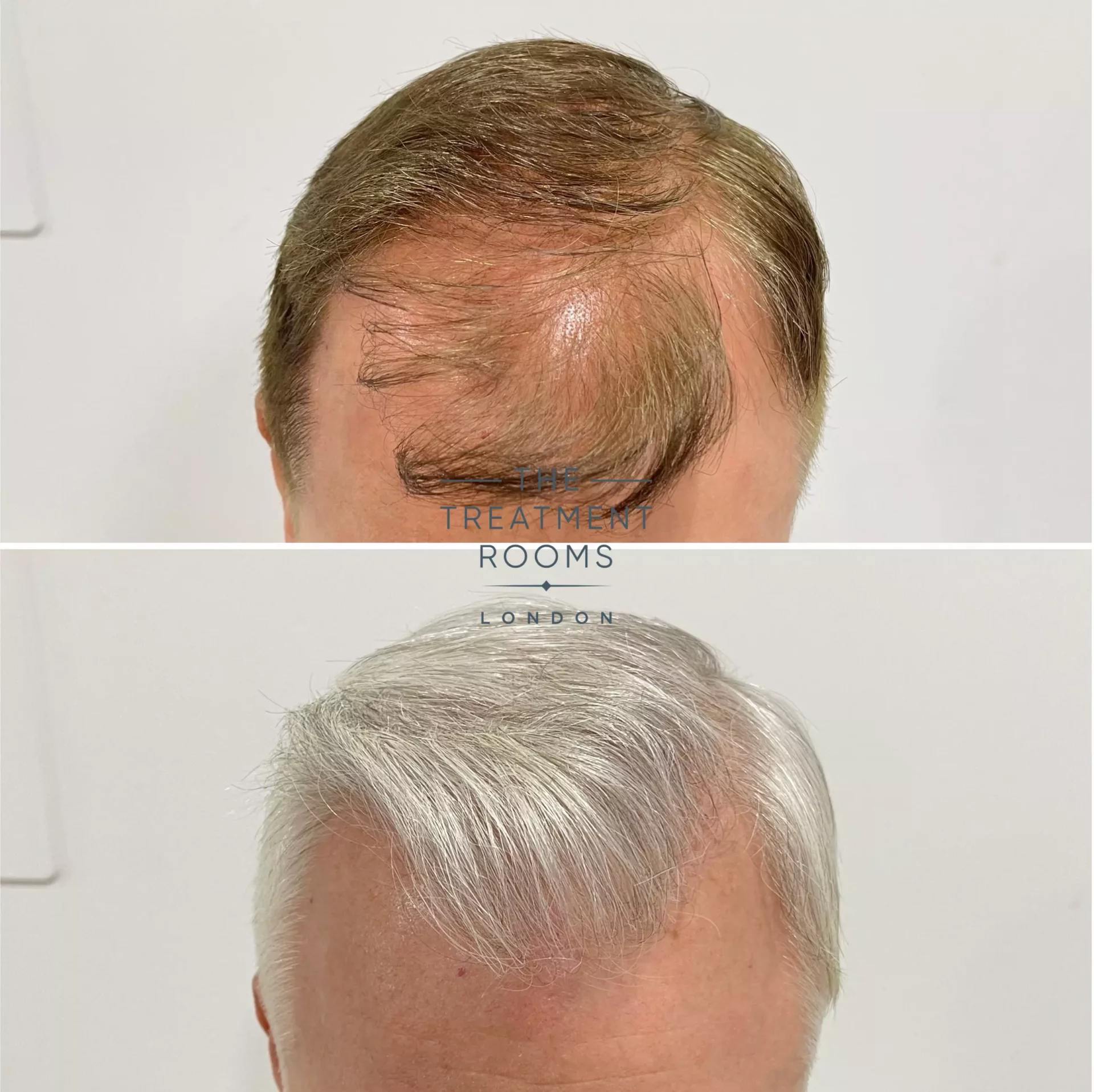 hairline hair transplant 1495 grafts before and after