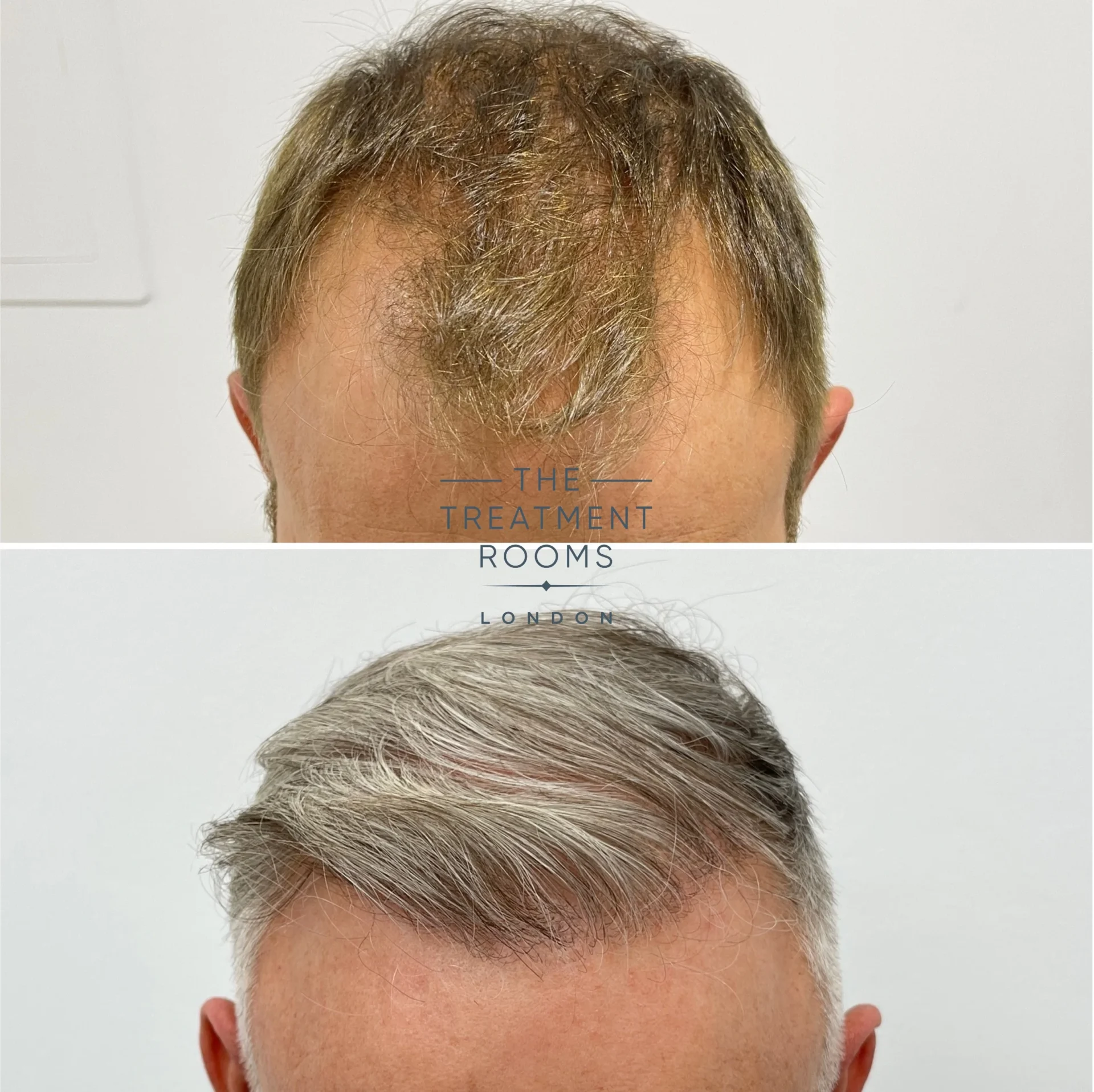 hairline hair transplant 1602 grafts before and after