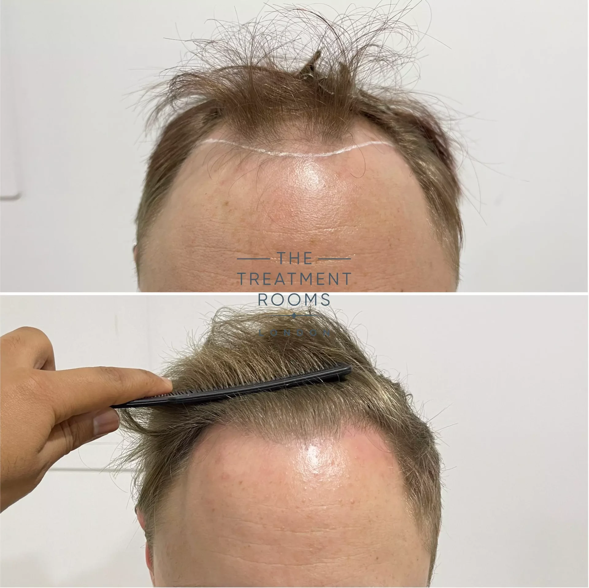 hairline hair transplant 1693 grafts before and after