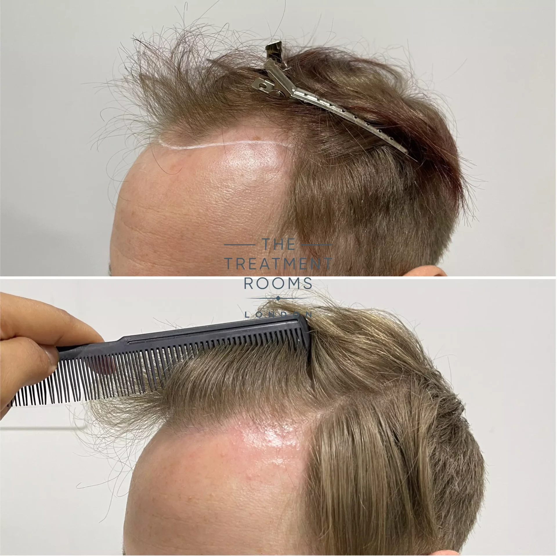 hairline hair transplant 1693 grafts result