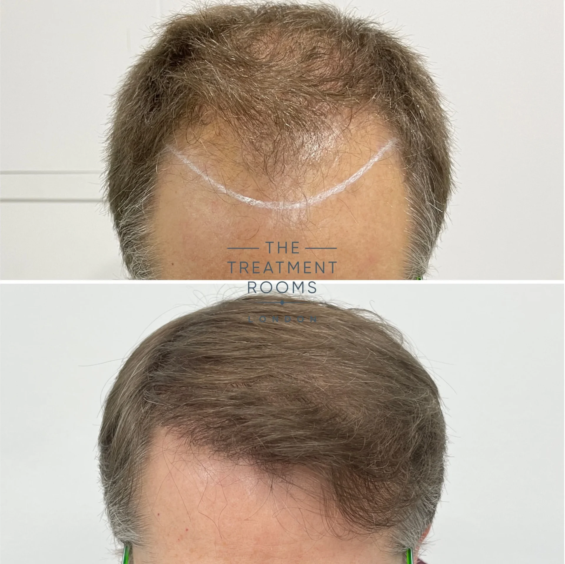 hairline hair transplant 1839 grafts before and after