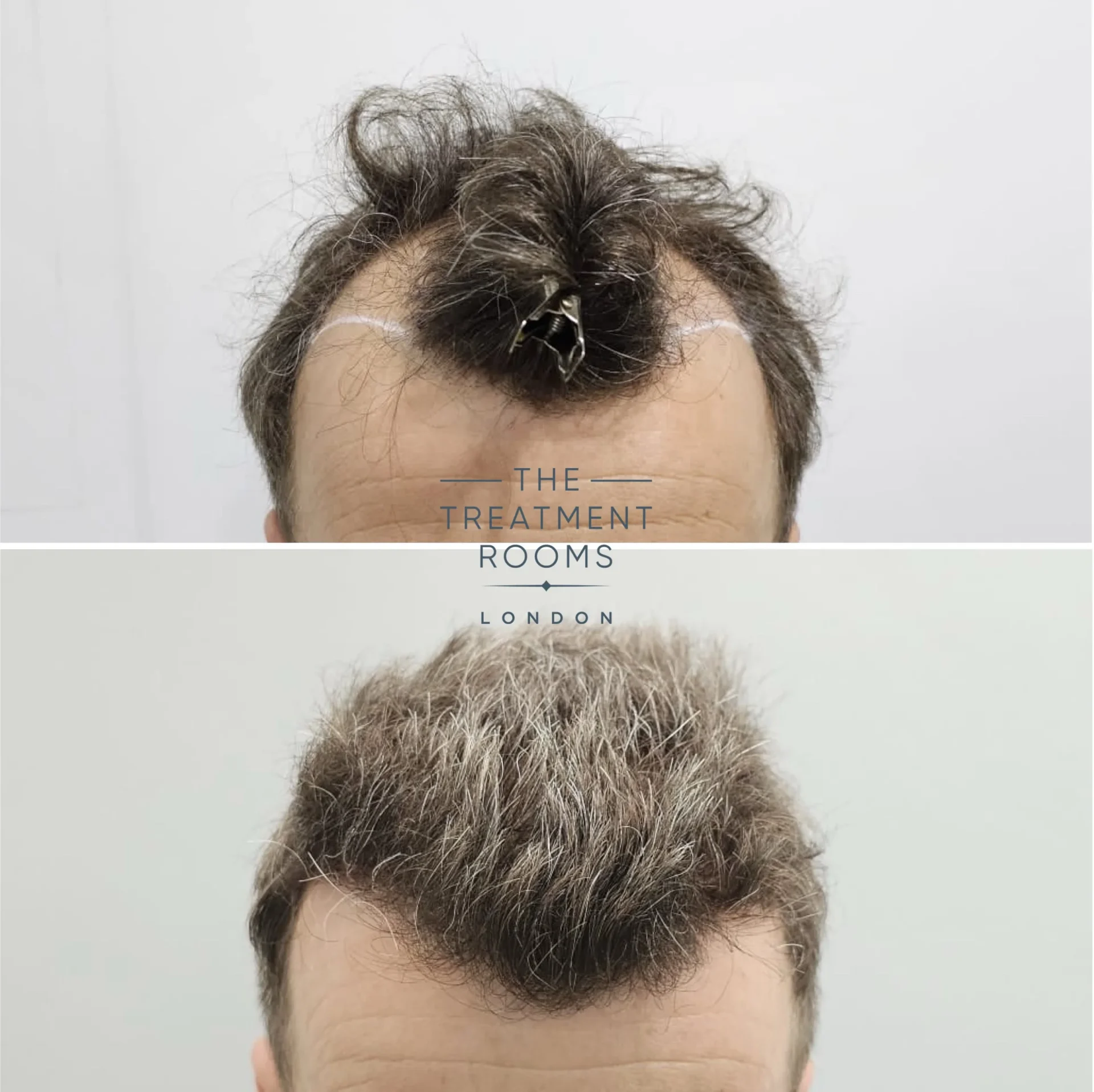 hairline hair transplant 1977 grafts grey hair before and after