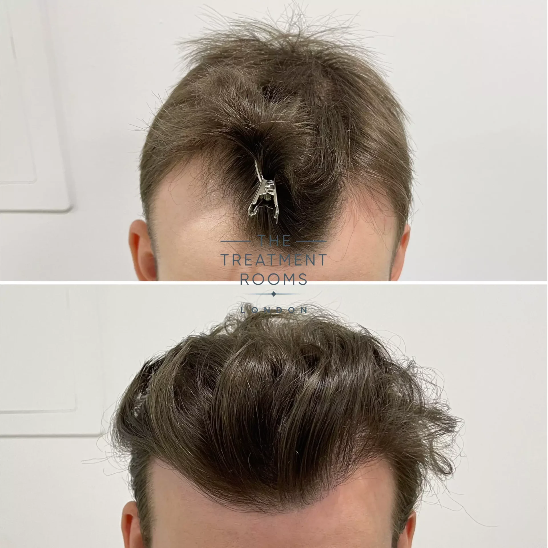 hairline hair transplant before and after 1357 grafts