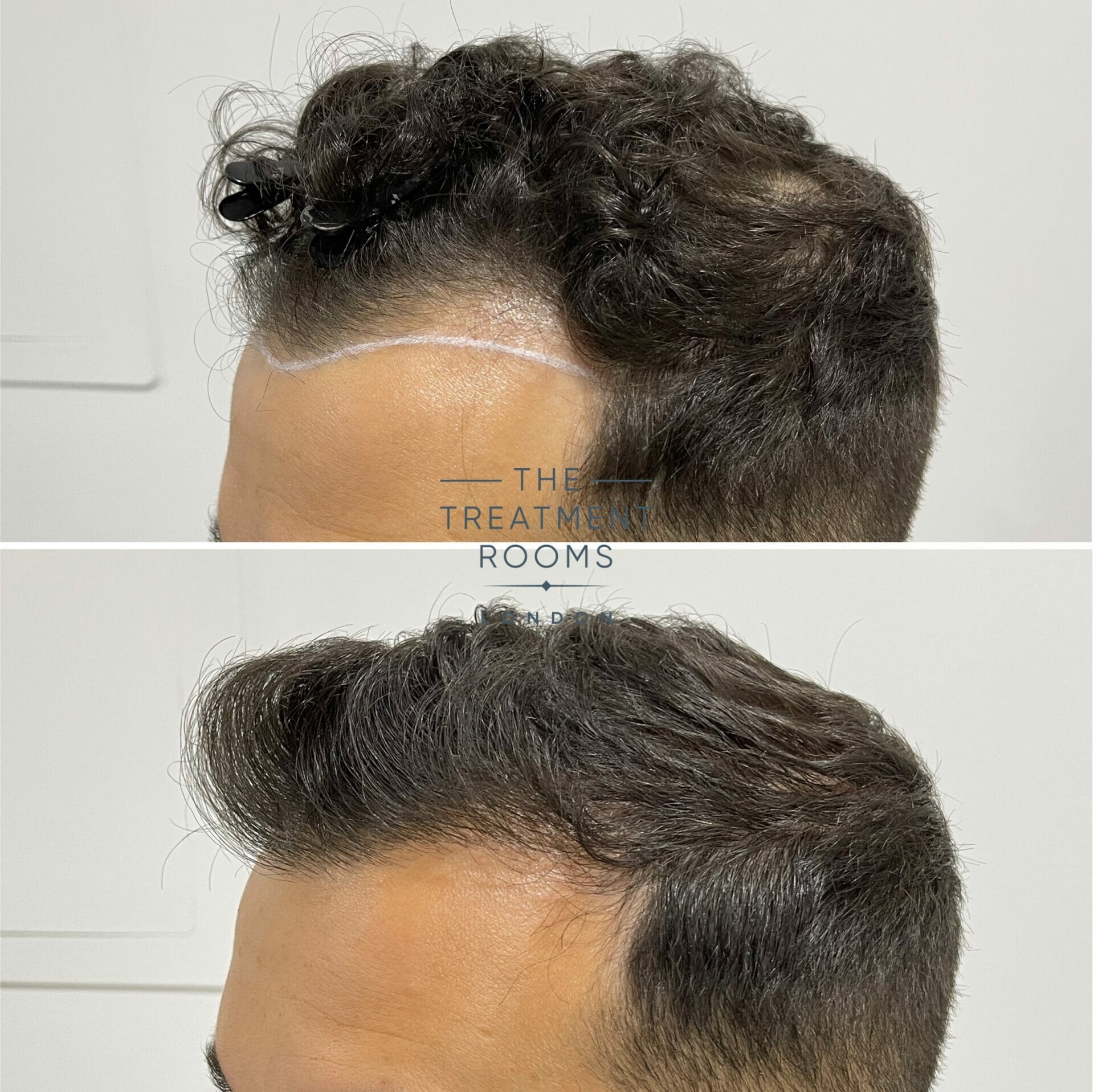 hairline hair transplant before and after 1552 grafts