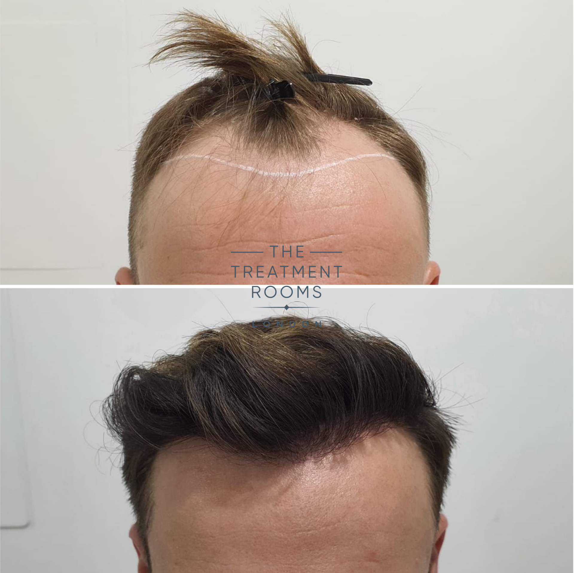 hairline hair transplant before and after 1724 grafts