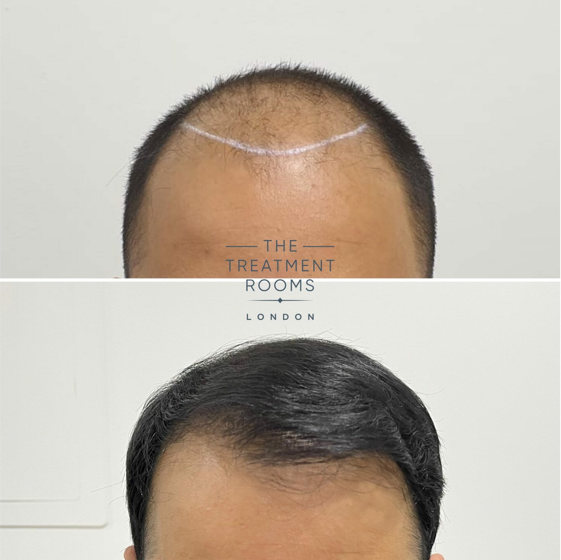 hairline hair transplant before and after 1911