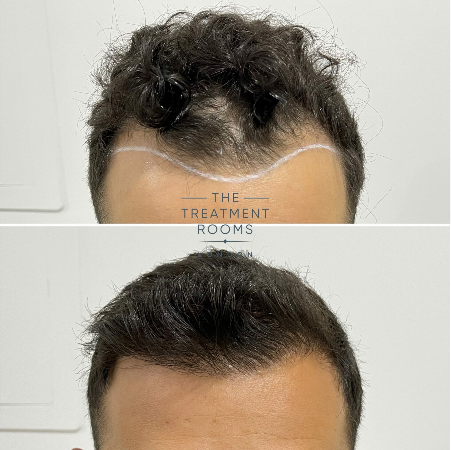 hairline hair transplant before and after