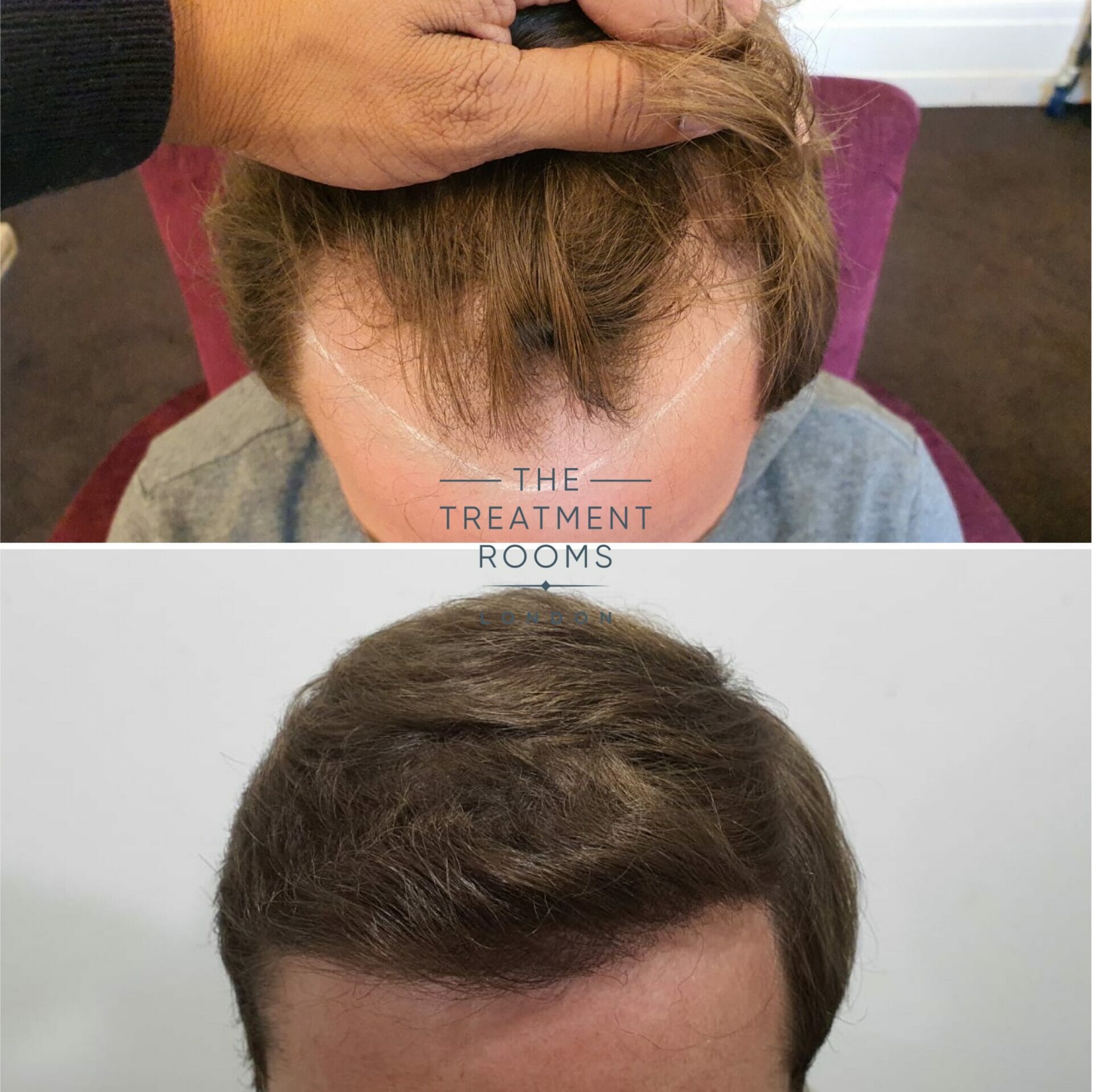 hairline hair transplant before and after 2018 grafts