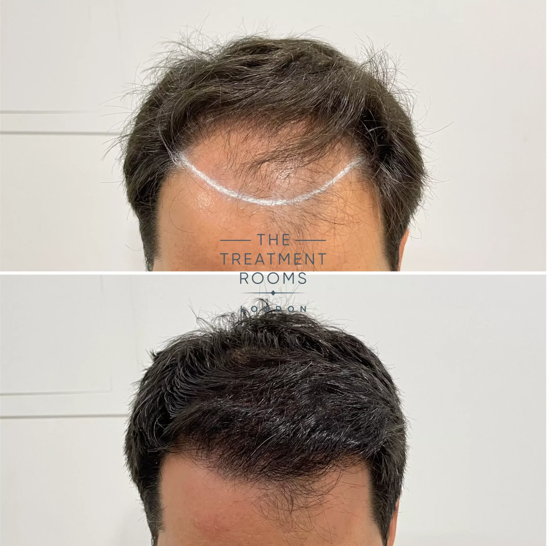 hairline hair transplant before and after 2170 grafts