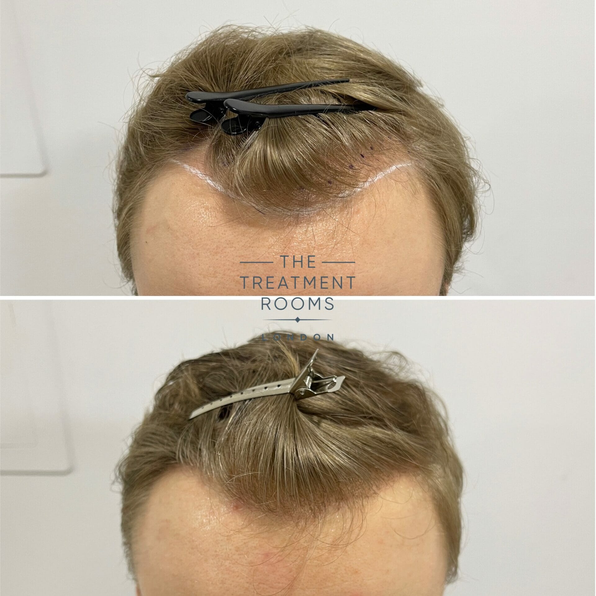 hairline hair transplant before and after 616 grafts