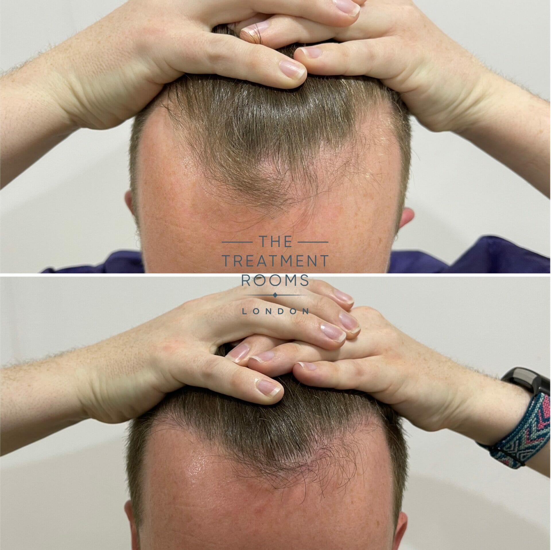 hairline hair transplant before and after closeup